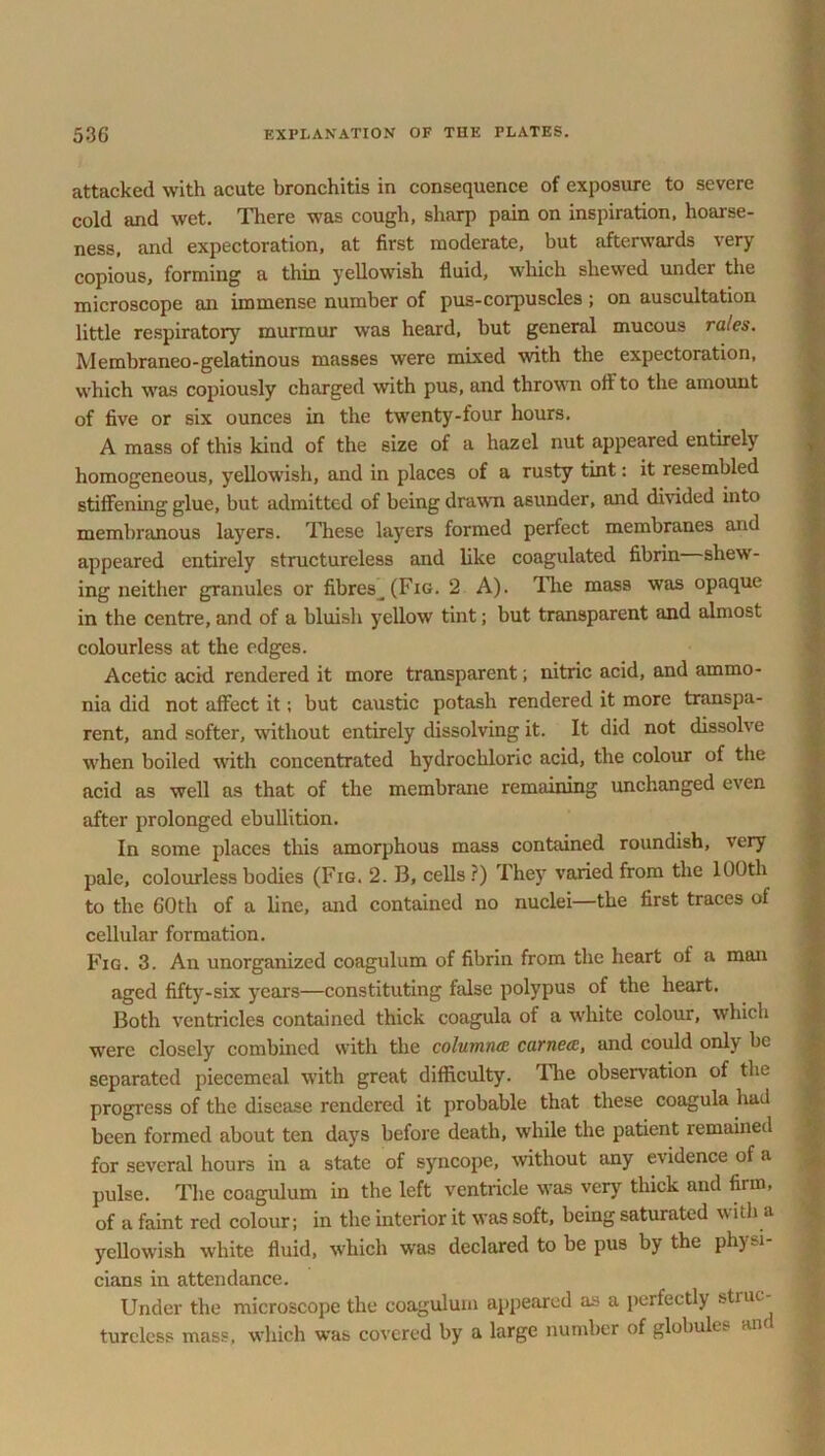 attacked with acute bronchitis in consequence of exposure to severe cold and wet. There was cough, sharp pain on inspiration, hoarse- ness, and expectoration, at first moderate, but afterwards very- copious, forming a thin yellowish fluid, which shewed under the microscope an immense number of pus-corpuscles ; on auscultation little respirator}' murmur was heard, but general mucous rales. Membraneo-gelatinous masses were mixed with the expectoration, which was copiously charged with pus, and thrown oti to the amount of five or six ounces in the twenty-four hours. A mass of this kind of the size of a hazel nut appeared entirely homogeneous, yellowish, and in places of a rusty tint: it resembled stiffening glue, but admitted of being drawn asunder, and divided into membranous layers. These layers formed perfect membranes and appeared entirely structureless and like coagulated fibrin shew- ing neither granules or fibres^(Fig. 2 A). The mass was opaque in the centre, and of a bluish yellow tint; but transparent and almost colourless at the edges. Acetic acid rendered it more transparent; nitric acid, and ammo- nia did not affect it; but caustic potash rendered it more transpa- rent, and softer, without entirely dissolving it. It did not dissolve when boiled with concentrated hydrochloric acid, the colour of the acid as well as that of the membrane remaining unchanged even after prolonged ebullition. In some places this amorphous mass contained roundish, very pale, colourless bodies (Fig. 2.13, cells ?) They varied from the 100th to the 60th of a line, and contained no nuclei—the first traces of cellular formation. Fig. 3. An unorganized coagulum of fibrin from the heart of a man aged fifty-six years—constituting false polypus of the heart. Both ventricles contained thick coagula of a white colour, which were closely combined with the columns carnecc, and could only be separated piecemeal with great difficulty, lhe observation of the progress of the disease rendered it probable that these coagula had been formed about ten days before death, while the patient remained for several hours in a state of syncope, without any evidence of a pulse. The coagulum in the left ventricle was very thick and firm, of a faint red colour; in the interior it was soft, being saturated with a yellowish white fluid, which was declared to be pus by the physi- cians in attendance. Under the microscope the coagulum appeared as a perfectly struc- tureless mass, which was covered by a large number of globules and