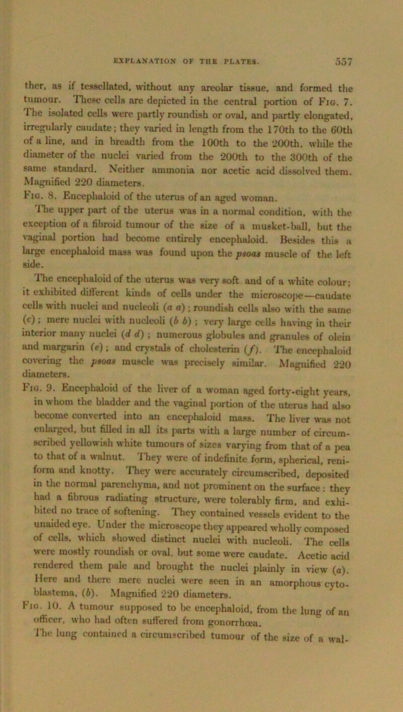 ther, as if tessellated, without any areolar tissue, and formed the tumour. I'liose cells are depicted in the central portion of Fig. 7. 1 lie isolated cells were partly roundish or oval, and partly elongated, irregularly caudate; they varied in length from the 170th to the 60th of a line, and in breadth from the 100th to the 200th. while the diameter of the nuclei varied from the 200th to the 300th of the same standard. Neither ammonia nor acetic acid dissolved them. Magnified 220 diameters. Fig. 8. Encephaloid of the uterus of an aged woman. 'Hie upper part of the uterus was in a normal condition, with the exception of a fibroid tumour of the size of a musket-ball, but the vaginal jrortion had become entirely encephaloid. Besides this a large encephaloid mass was found upon the psoas muscle of the left side. 'Hie encephaloid of the uterus was very soft and of a white colour ; it exhibited different kinds of cells under the microscope—caudate cells with nuclei and nucleoli (a a) ; roundish cells also with the same (c) ; mere nuclei with nucleoli (b b) ; very large cells having in their interior many nuclei (d d) ; numerous globules and granules of olein and margarm (e); and crystals of cholesterin (/). The encephaloid covering the psoas muscle was precisely similar. Magnified 220 diameters. I-us. 9. Encephaloid of the liver of a woman aged forty-eight years, in whom the bladder and the vaginal portion of the uterus had also become converted into an encephaloid mass. The liver W'as not enlarged, but tilled in all its parts with a large number of circum- scribed yellowish white tumours of sizes varying from that of a pea to that of a walnut, i hey w'ere of indefinite form, spherical, reni- form and knotty. They were accurately circumscribed, deposited in the normal parenchyma, and not prominent on the surface : they had a fibrous radiating structure, were tolerably firm, and exhi- bited no trace of softening. They contained vessels evident to the unaided eye. Under the microscope they appeared wholly composed of cells, which showed distinct nuclei with nucleoli. The cells were mostly roundish or oval, but some were caudate. Acetic acid rendered them pale and brought the nuclei plainly in view (a). Here and there mere nuclei were seen in an amorphous cyto- blastema, (b). Magnified 220 diameters. Fig. 10. A tumour supposed to be encephaloid, from the lung of an officer, who had often suffered from gonorrhcca. l’he lung contained a circumscribed tumour of the size of a wal-