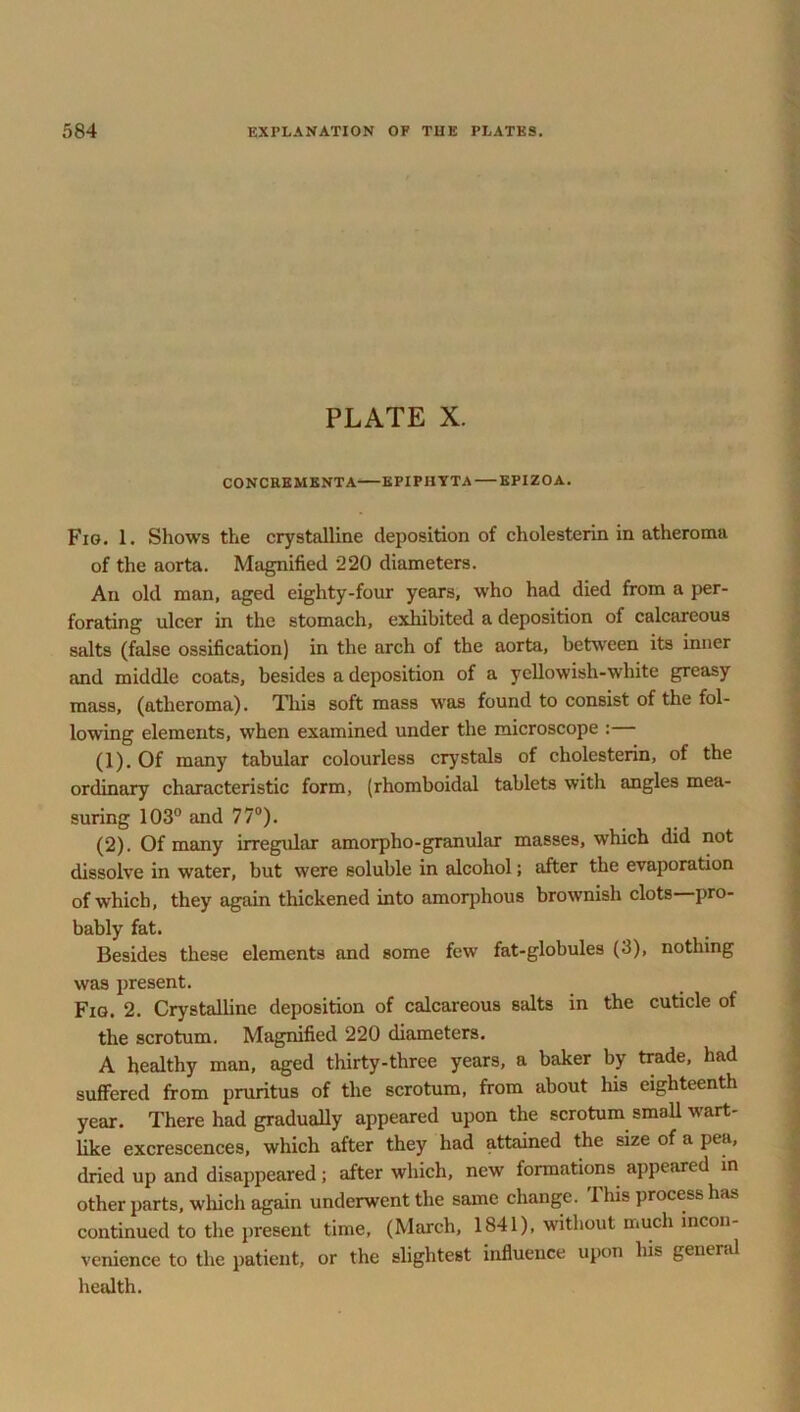 PLATE X. CONCREMENT A EPIPHYTA EPIZOA. Fig. 1. Shows the crystalline deposition of cholesterin in atheroma of the aorta. Magnified 220 diameters. An old man, aged eighty-four years, who had died from a per- forating ulcer in the stomach, exhibited a deposition of calcareous salts (false ossification) in the arch of the aorta, between its inner and middle coats, besides a deposition of a yellowish-white greasy mass, (atheroma). This soft mass was found to consist of the fol- lowing elements, when examined under the microscope :— (1) . Of many tabular colourless crystals of cholesterin, of the ordinary characteristic form, (rhomboidal tablets with angles mea- suring 103° and 77°). (2) . Of many irregular amorpho-granular masses, which did not dissolve in water, but were soluble in alcohol; after the evaporation of which, they again thickened into amorphous brownish clots pro- bably fat. Besides these elements and some few fat-globules (3), nothing was present. Fig. 2. Crystalline deposition of calcareous salts in the cuticle of the scrotum. Magnified 220 diameters. A healthy man, aged thirty-three years, a baker by trade, had suffered from pruritus of the scrotum, from about his eighteenth year. There had gradually appeared upon the scrotum small wart- like excrescences, which after they had attained the size of a pea, dried up and disappeared; after which, new formations appeared in other parts, which again underwent the same change. 1 his process has continued to the present time, (March, 1841), without much incon- venience to the patient, or the slightest influence upon his general health.