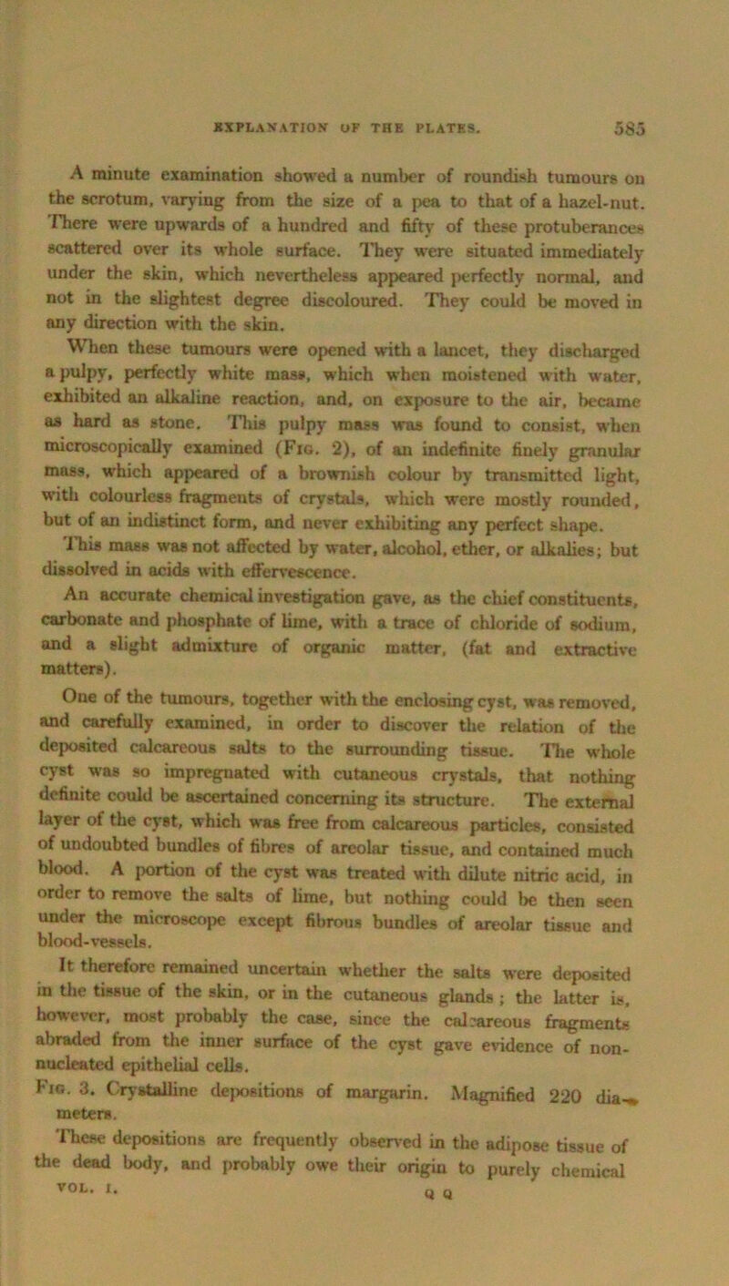 A minute examination showed a number of roundish tumours on the scrotum, varying from the size of a pea to that of a hazel-nut. rhere were upwards of a hundred and fifty of these protuberances scattered over its whole surface. They were situated immediately under the skin, which nevertheless appeared perfectly normal, and not in the slightest degree discoloured. They could be moved in any direction witli the skin. When these tumours were opened with a lancet, they discharged a pulpy, perfectly white mass, which when moistened with water, exhibited an alkaline reaction, and, on exposure to the air. became as hard as stone. This pulpy mass was found to consist, when microscopically examined (Fio. 2), of an indefinite finely granular mass, which appeared of a brownish colour by transmitted light, with colourless fragments of crystals, which were mostly rounded, but of an indistinct form, and never exhibiting any perfect shape. I his mass was not affected by water, alcohol, ether, or alkalies; but dissolved in acids with effervescence. An accurate chemical investigation gave, as the chief constituents, carbonate and phosphate of lime, with a trace of chloride of sodium, and a slight admixture of organic matter, (fat and extractive matters). One of the tumours, together with the enclosing cyst, was removed, and carefully examined, in order to discover the relation of the deposited calcareous salts to the surrounding tissue. The whole cyst was so impregnated with cutaneous crystals, that nothing definite could be ascertained concerning its structure. The external layer of the cyst, which was free from calcareous particles, consisted of undoubted bundles of fibres of areolar tissue, and contained much blood. A portion of the cyst was treated with dilute nitric acid, in order to remove the salts of lime, but nothing could be then seen under the microscope except fibrous bundles of areolar tissue and blood-vessels. It therefore remained uncertain whether the salts were deposited in the tissue of the skin, or in the cutaneous glands ; the latter is, however, most probably the case, since the calcareous fragment- abraded from the inner surface of the cyst gave evidence of non- nucleatcd epithelial cells. Fio. 3. Crystalline depositions of margarin. Magnified 220 dia-* meters. These depositions are frequently observed in the adipose tissue of the dead body, and probably owe their origin to purely chemical VOL. i. 0 0