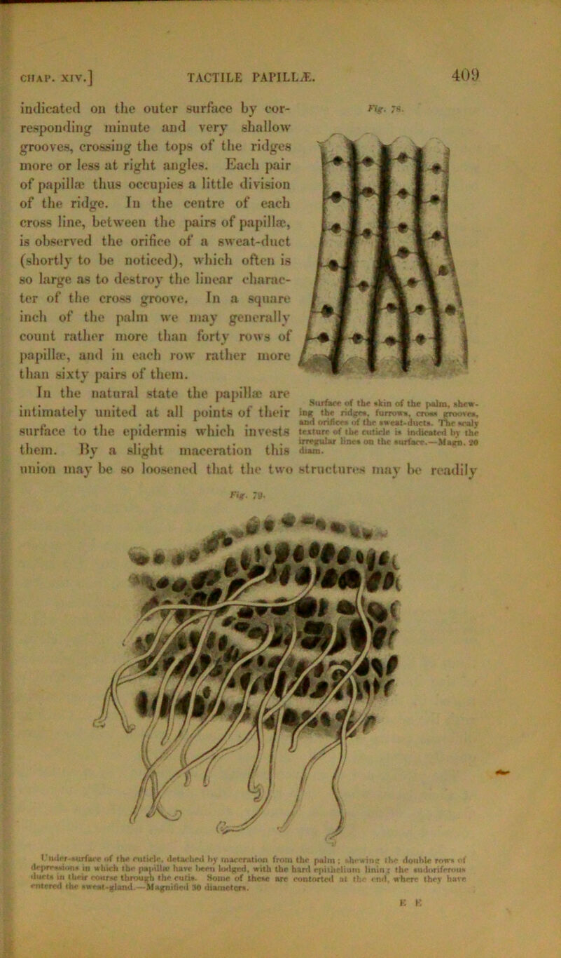 indicated on the outer surface by cor- «<r- *«• responding minute and very shallow grooves, crossing the tops of the ridges more or less at right angles. Each pair of papillae thus occupies a little division of the ridge. In the centre of each cross line, between the pairs of papillae, is observed the orifice of a sweat-duct (shortly to he noticed), which often is so large as to destroy the linear charac- ter of the cross groove. In a square inch of the palm we may generally count rather more than forty rows of papillae, and in each row rather more than sixty pairs of them. In the natural state the papillse are . . , •,! it . , , . Surface of the »kin of the palm, shew- intimateiv united at all points of their >ng «*>« rido*-.. fum>*», cm*, groove*, , * , . , and orifice, of (he twrut-duct*. The valy surface to the epidermis which invests teUurr of the cutirlr i. indicated I.V the ,, ... ... irregular tine* on the surface.—Maim. 20 them. Hy a slight maceration this di»m. union may he so loosened that the two structures mav he readily 7y. riwicr-vurfai c of the ftttide, detached hy maceration froiu the palm ; ahewine the double row* nt depreaaton* in which rhe papilla? have lieen lodged, with the hard epithelium limn ; the »udoriferouf* duets in their co*tr*e through the Home of theae are contorted at the end, where they have entered the * weal-gland-Magnified 30 diameter*. K K