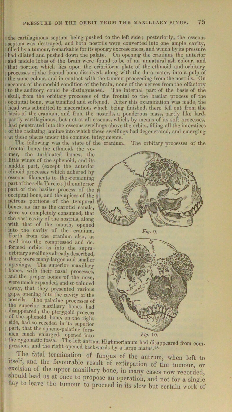 i 1 : the cartilaginous septum being pushed to the left side; posteriorly, the osseous ! septum was destroyed, and both nostrils were converted into one ample cavity, t filled by a tumour, remarkable for its spongy excrescences, and which by its pressure 1 had dilated and pushed down the palate. On opening the cranium, the anterior ! and middle lobes of the brain were found to be of an unnatural ash colour, and ithat portion which lies upon the cribriform plate of the ethmoid and orbitary j)rocesses of the frontal bone dissolved, along with the dura mater, into a pulp of the same colour, and in contact with the tumour proceeding from the nostrils. On account of the morbid condition of the brain, none of the nerves from the olfactory to the auditory could be distinguished. The internal part of the basis of the skull, from the orbitary processes of the frontal to the basilar process of the occipital bone, was tumified and softened. After this examination was made, the head was submitted to maceration, which being finished, there fell out from the basis of the cranium, and from the nostrils, a ponderous mass, partly like lard, Eartly cartilaginous, but not at all osseous, which, by means of its soft ])rocesses, ad penetrated into the osseous swellings above the orbits, tilting all the interstices of the radiating laminm into which these swellings had degenerated, and emerging at these places under the common integuments. The following was the state of the cranium. The orbitary processes of the frontal bone, the ethmoid, the vo- mer, the turbinated bones, the little wings of the sphenoid, and its middle part, (excej)t the anterior clinoid processes which adhered by osseous filaments to the •remaining part of the sella Turcica,) the anterior part of the basilar process of the occipital bone, and the apices of the petrous portions of the temporal bones, as far as the carotid canals, were so completely consumed, that the vast cavitjr of the nostrils, along with that of the mouth, opened into the cavity of the cranium. Forth from the cranium also, as well into the compressed and de- formed orbits as into the supra- orbitary swellings already described, there were many larger and smaller openings. The superior maxillary bones, with their nasal processes, and the proper bones of the nose, were much expanded, and so thinned away, that they ])resented various gaps, opening into the cavity of the nostrils. The ]ialatine processes of the superior maxillary bones had disappeared; the pterygoid process of the sphenoid bone, on the right side, had so receded in its superior part, that the spheno-palatine fora- men much enlarged, opened into the zygomatic fossa. The left antrum Highmorianum had disappeared from com. pression, and the right opened backwards by a large hiatus.‘-^8 The fatal termination of fungus of the antrum, when left to itselt, and the favourable result of extirpation of the tumour, or excision of the upper maxillary bone, in many cases now recorded, should lead us at once to propose an operation, and not for a single day to leave the tumour to proceed in its slow but certain work of Fig. 9. Fig* 10. 1
