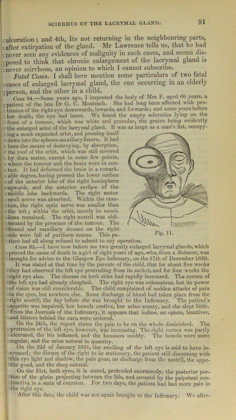 ulceration; and 4th, Its not returning in the neighbouring parts, i after extirpation of the gland. Mr Lawrence tells us, that he had I never seen any evidences of malignity in such cases, and seems dis— jposed to think that chronic enlargement of the lacrymal gland is I never scirrhous, an opinion to which I cannot subscribe. Fatal Cases. I shall here mention some particulars of two fatal (cases of enlarged lacrymal gland, the one occurring in an elderly i person, and the other in a child. Case 94.—Some years ago, I inspected the body of Mrs F. aged 60 years, a I patient of the late Dr G. C. Monteath. Slie had long been affected with pro- ; trusionof the right eye downwards, inwards, and forwards; and some years before n her death, the eye had burst. We found the empty sclerotica lying on the ■ front of a tumour, which was white and granular, the grains being evidently the enlarged acini of the lacrymal gland. It was as large as a man’s list, occupy- ■ ] inga much expanded orbit, and pressing itself down into the spheno-maxillary fissure. It had been the means of destroying, by absorption, the roof of the orbit, which was still covered ■ by dura mater, except in some few points, . where the tumour and the brain were in con- - tact. It had deformed the brain in a reniark- ^ able degree, having pressed the lower surface 1,1 of the anterior lobe of the right hemisphere uupwards, and the anterior surface of the n middle lobe backwards. The right motor ooculi nerve was absorbed. Within the cran- iiium, the right optic nerve was smaller than ' the left; within the orbit, merely its neuri- 'nlema remained. The right nostril was obli- iterated by the presence of the tumour. The i'frontal and maxillary sinuses on the right > side were full of puriform mucus. This ])a- tient had all along refused to submit to any operation. Case 95.—I have now before me two greatly enlarged lacrymal glands, which , proved the cause of death in a girl of eight years of age, who, from a distance, was brought for advice to the Glasgow Eye Infirmary, on the 17th of December 1830. It was stated at that time by the parents of the child, that for about five weeks they had observed the left eye protruding from its socket, and for four weeks the right eye also. The disease on both sides had rapidly increased. Tho cornea of a the left eye had already sloughed. The right eye was axleinatous, but its power \ of vision was still considerable. The child complained of sudden attacks of pain I in the eyes, but nowhere else. Some discharge of blood had taken place from the ? right nostril, the day before she was brought to the Infirmary. The patient’s ; appetite was impaired, her bowels costive, her urine scanty, and she slept little. - From the Journals of the Infirmary, it appears that iodine, an opiate, laxatives, Jand blisters behind the cars, were ordered. On the 24th, the report states the pain to be on the whole diminished. The I protrusion of the left eye, however, was increasing. The right cornea was partly I ulcerated, the iris inflamed, and the humours muddy. The bowels were more S regular, and the urine natural in quantity. I On the 22d of January 1831, the swelling of the left eye is said to have in- I creased; the disease of the right to be stationary, the patient still discerning with * this eye light and shadow, the pain gone, no discharge from tho nostril, the aj)pc- ? tite good, and the sleep natural. ' On the 31st, both eyes, it is stated, protruded enormously, the posterior por- ;; tion of the globe projecting between the lids, and covered by the palpebral con- < junctiva in a state of eversion. For two days, the patient had had more pain in the right eye. After this date, the child was not again brought to the Infirmary. We after-