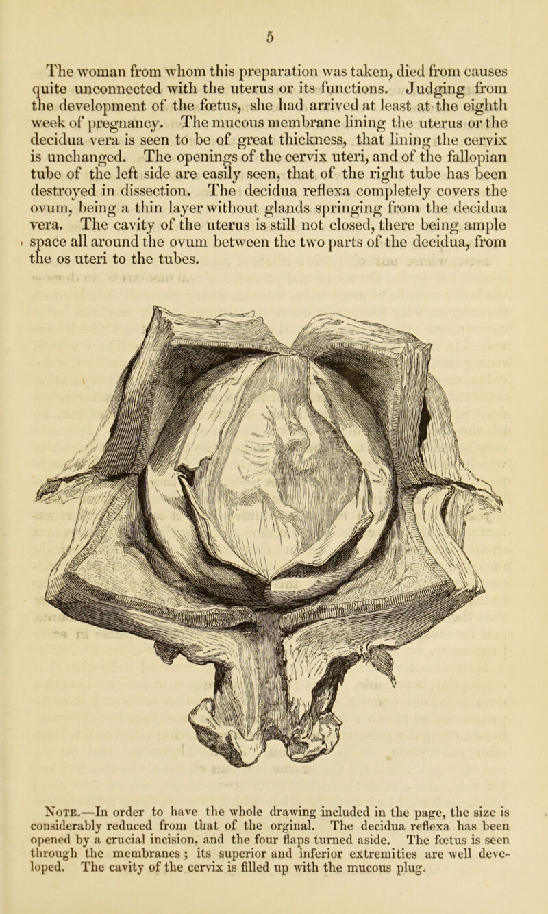 The woman from whom this preparation was taken, died from causes quite unconnected with the uterus or its functions. Judging from the development of the foetus, she had arrived at least at the eighth week of pregnancy. The mucous membrane lining the uterus or the decidua vera is seen to be of great thickness, that lining the cervix is unchanged. The openings of the cervix uteri, and of the fallopian tube of the left side are easily seen, that of the right tube has been destroyed in dissection. The decidua reflexa completely covers the ovum, being a thin layer without glands springing from the decidua vera. The cavity of the uterus is still not closed, there being ample • space all around the ovum between the two parts of the decidua, from the os uteri to the tubes. Note.—In order to have the whole drawing included in the page, the size is considerably reduced from that of the orginal. The decidua reflexa has been opened by a crucial incision, and the four flaps turned aside. The foetus is seen through the membranes ; its superior and inferior extremities are well deve- loped. The cavity of the cervix is filled up with the mucous plug.