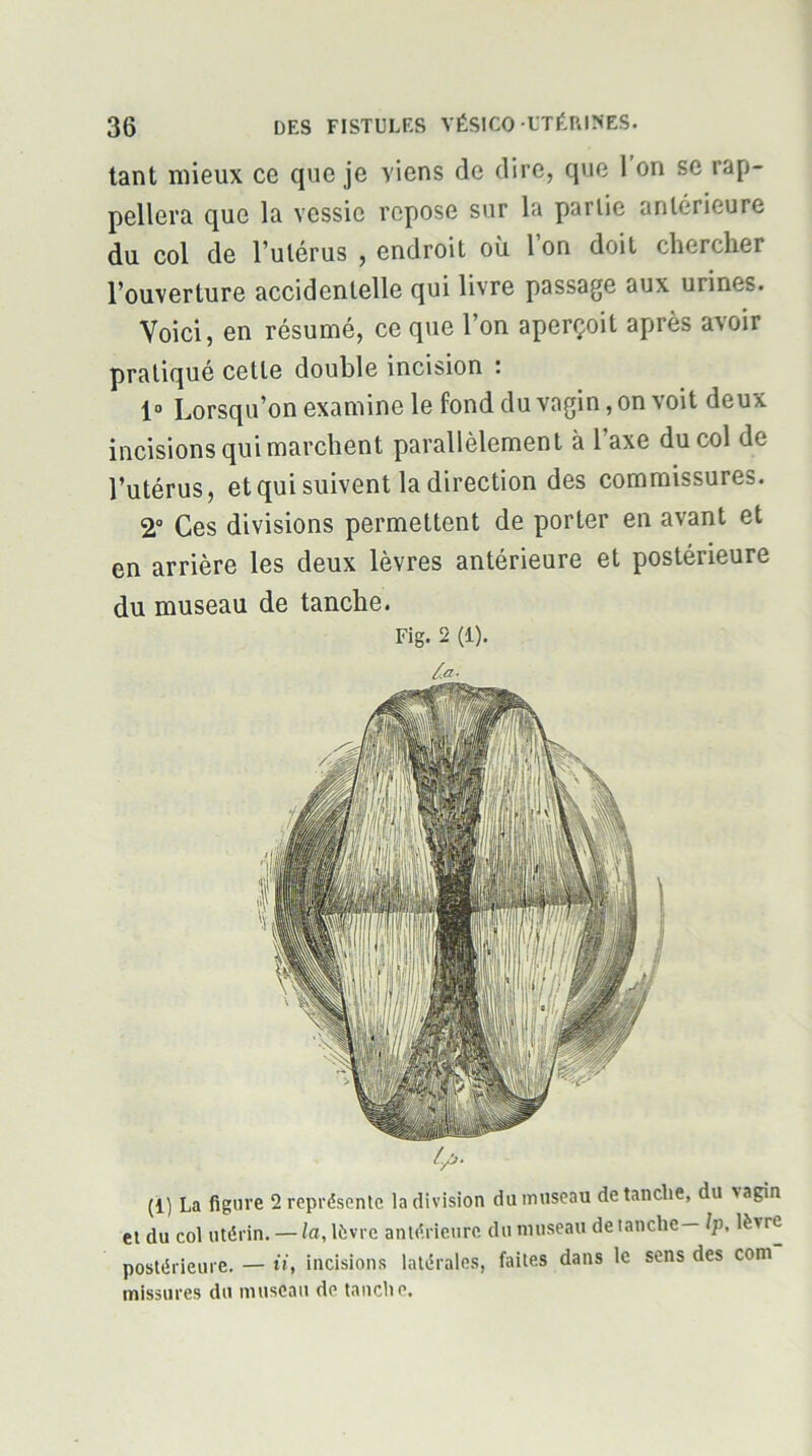 tant mieux ce que je viens de dire, que 1 on se rap- pellera que la vessie repose sur la partie antérieure du col de l’utérus , endroit où 1 on doit chercher l’ouverture accidentelle qui livre passage aux urines. Voici, en résumé, ce que l’on aperçoit après avoir pratiqué cette double incision : 1“ Lorsqu’on examine le fond du vagin, on voit deux incisions qui marchent parallèlement à l’axe du col de l’utérus, et qui suivent la direction des commissures. 2“ Ces divisions permettent de porter en avant et en arrière les deux lèvres antérieure et postérieure du museau de tanche. Fig. 2 (1). l.a- L^. (1) La figure 2 représente la division du museau de tanche, du >agin et du col utérin. — la, lèvre antérieure du museau de tanche— Ip, lèvre postérieure, — ii, incisions latérales, faites dans le sens des com missures du museau de tanche.