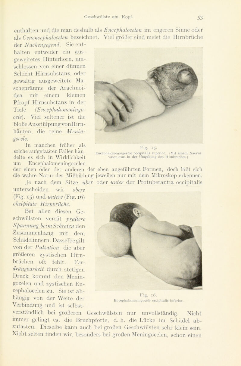 m Fig. 15. Encephalomeningocele occipitalis superior. (Mit einem Naevus vasculosus in der Umgebung des Himbruches.) enthalten und die man deshalb als Encephalocelen im engeren Sinne oder als Cenencephalocelen bezeichnet. Viel größer sind meist die Hirnbrüche der Nackengegend. Sie ent- halten entweder ein aus- geweitetes Hinterhorn, um- schlossen von einer dünnen Schicht Hirnsubstanz, oder gewaltig ausgeweitete Ma- schenräume der Arachnoi- dea mit einem kleinen Pfropf Hirnsubstanz in der Tiefe (Encephalomeningo- cele). Viel seltener ist die bloße Ausstülpung vonHirn- häuten, die reine Menin- gocele. In manchen früher als solche aufgefaßten Fällen han- delte es sich in Wirklichkeit um Encephalomeningocelen der einen oder der anderen der eben angeführten Formen, doch läßt sich die wahre Natur der Mißbildung jeweilen nur mit dem Mikroskop erkennen. Je nach dem Sitze über oder unter der Protuberantia occipitalis unterscheiden wir obere (Fig. 15) und untere (Fig. 16) okzipitale Hirnbrüche. Bei allen diesen Ge- schwülsten verrät prallere Spannung beim Schreien den Zusammenhang mit dem Schädelinnern. Dasselbe gilt von der Pulsation, die aber größeren zystischen Hirn- briiehen oft fehlt. Ver- drängbarkeit durch stetigen Druck kommt den Menin- gozelen und zystischen En- cephalocelen zu. Sie ist ab- hängig von der Weite der Verbindung und ist selbst- verständlich bei größeren Geschwülsten nur unvollständig. Nicht immer gelingt es, die Bruchpforte, d. h. die Lücke im Schädel ab- zutasten. Dieselbe kann auch bei großen Geschwülsten sehr klein sein. Nicht selten finden wir, besonders bei großen Meningocclen, schon einen Fig. 16. Encephalomeningocele occipitalis inferior.