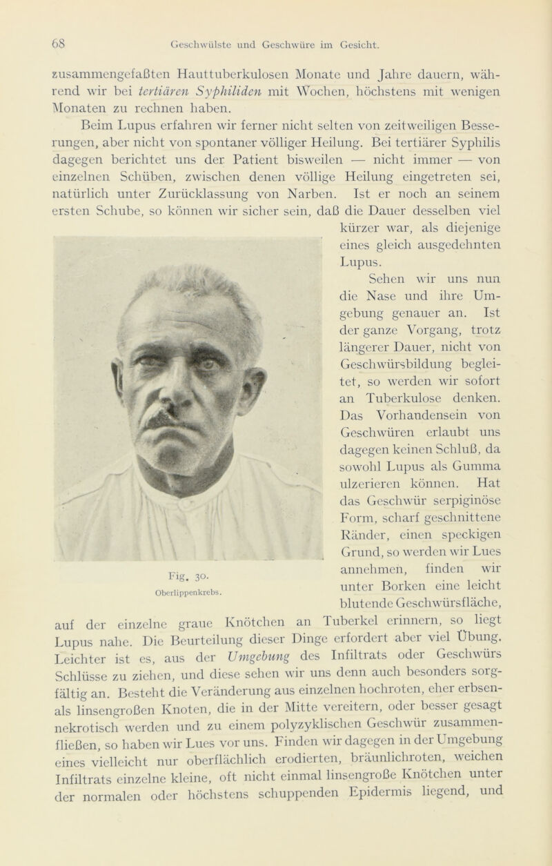 zusammengefaßten Hauttuberkulosen Monate und Jahre dauern, wäh- rend wir bei tertiären Syphiliden mit Wochen, höchstens mit wenigen Monaten zu rechnen haben. Beim Lupus erfahren wir ferner nicht selten von zeitweiligen Besse- rungen, aber nicht von spontaner völliger Heilung. Bei tertiärer Syphilis dagegen berichtet uns der Patient bisweilen — nicht immer — von einzelnen Schüben, zwischen denen völlige Heilung eingetreten sei, natürlich unter Zurücklassung von Narben. Ist er noch an seinem ersten Schube, so können wir sicher sein, daß die Dauer desselben viel kürzer war, als diejenige eines gleich ausgedehnten Lupus. Sehen wir uns nun die Nase und ihre Um- gebung genauer an. Ist der ganze Vorgang, trotz längerer Dauer, nicht von Geschwürsbildung beglei- tet, so werden wir sofort an Tuberkulose denken. Das Vorhandensein von Geschwüren erlaubt uns dagegen keinen Schluß, da sowohl Lupus als Gumma ulzerieren können. Hat das Geschwür serpiginöse Form, scharf geschnittene Ränder, einen speckigen Grund, so werden wir Lues annehmen, finden wir unter Borken eine leicht blutende Geschwürsfläche, auf der einzelne graue Knötchen an Tuberkel eiinnern, so liegt Lupus nahe. Die Beurteilung dieser Dinge erfordert aber viel Übung. Leichter ist es, aus der Umgebung des Infiltrats oder Geschwürs Schlüsse zu ziehen, und diese sehen wir uns denn auch besonders sorg- fältig an. Besteht die Veränderung aus einzelnen hochroten, eher erbsen- als linsengroßen Knoten, die in der Mitte vereitern, odei bcssci gesagt nekrotisch werden und zu einem polyzyklischen Geschwür zusammen- fließen, so haben wir Lues vor uns. Finden wir dagegen in der Umgebung eines vielleicht nur oberflächlich erodierten, bräunlichroten, weichen Infiltrats einzelne kleine, oft nicht einmal linsengroße Knötchen unter der normalen oder höchstens schuppenden Epidermis liegend, und Fig. 30.