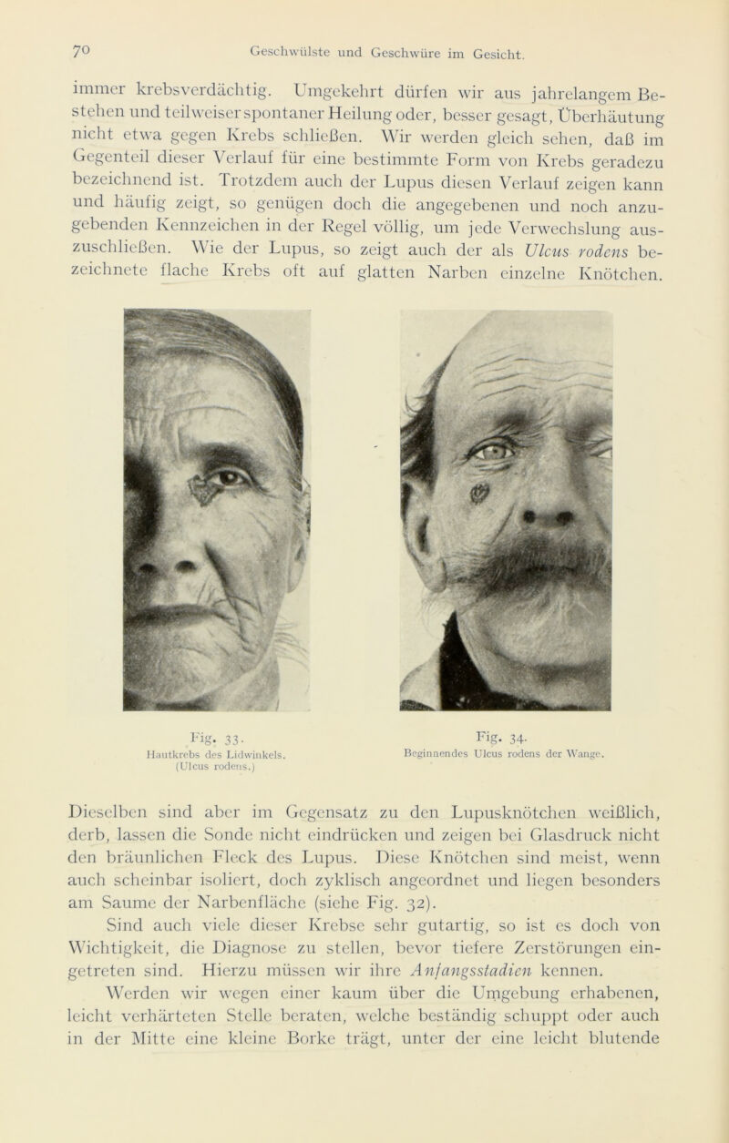 immer krebsverdächtig. Umgekehrt dürfen wir aus jahrelangem Be- stehen und teilweiser spontaner Heilung oder, besser gesagt, Überhäutung nicht etwa gegen Krebs schließen. Wir werden gleich sehen, daß im Gegenteil dieser Verlauf für eine bestimmte Form von Krebs geradezu bezeichnend ist. Trotzdem auch der Lupus diesen Verlauf zeigen kann und häufig zeigt, so genügen doch die angegebenen und noch anzu- gebenden Kennzeichen in der Regel völlig, um jede Verwechslung aus- zuschließen. Wie der Lupus, so zeigt auch der als Ulcus rodens be- zeichnete flache Krebs oft auf glatten Narben einzelne Knötchen. Hautkrebs des Lidwinkels. Beginnendes Ulcus rodens der Wange. (Ulcus rodens.) Dieselben sind aber im Gegensatz zu den Lupusknötchen weißlich, derb, lassen die Sonde nicht eindrücken und zeigen bei Glasdruck nicht den bräunlichen Fleck des Lupus. Diese Knötchen sind meist, wenn auch scheinbar isoliert, doch zyklisch angeordnet und liegen besonders am Saume der Narbenfläche (siehe Fig. 32). Sind auch viele dieser Krebse sehr gutartig, so ist cs doch von Wichtigkeit, die Diagnose zu stellen, bevor tiefere Zerstörungen ein- getreten sind. Hierzu müssen wir ihre Anjangsstadien kennen. Werden wir wegen einer kaum über die Umgebung erhabenen, leicht verhärteten Stelle beraten, welche beständig schuppt oder auch in der Mitte eine kleine Borke trägt, unter der eine leicht blutende