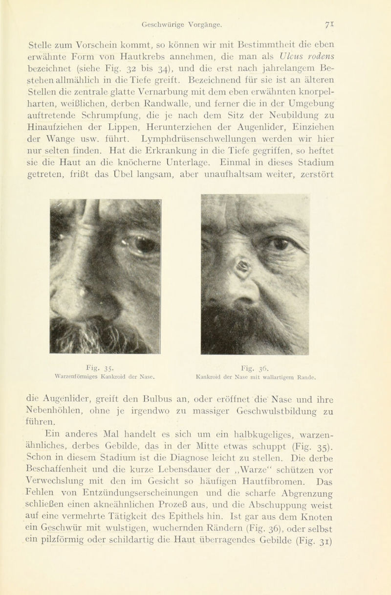 Stelle zum Vorschein kommt, so können wir mit Bestimmtheit die eben erwähnte Form von Hautkrebs annehmen, die man als Ulcus rodens bezeichnet (siehe Fig. 32 bis 34), und die erst nach jahrelangem Be- stehenallmählich in die Tiefe greift. Bezeichnend für sie ist an älteren Stellen die zentrale glatte Vernarbung mit dem eben erwähnten knorpel- harten, weißlichen, derben Randwalle, und ferner die in der Umgebung auftretende Schrumpfung, die je nach dem Sitz der Neubildung zu Hinaufziehen der Lippen, Herunterziehen der Augenlider, Einziehen der Wange usw. führt. Lymphdrüsenschwellungen werden wir hier nur selten finden. Hat die Erkrankung in die Tiefe gegriffen, so heftet sie die Haut an die knöcherne Unterlage. Einmal in dieses Stadium getreten, frißt das Übel langsam, aber unaufhaltsam weiter, zerstört Warzenförmiges Kankroid der Nase. Fig. 36. Kankroid der Nase mit wallartigem Rande. die Augenlider, greift den Bulbus an, oder eröffnet die Nase und ihre Nebenhöhlen, ohne je irgendwo zu massiger Geschwulstbildung zu führen. Ein anderes Mal handelt cs sich um ein halbkugeliges, warzen- ähnliches, derbes Gebilde, das in der Mitte etwas schuppt (Fig. 35). Schon in diesem Stadium ist die Diagnose leicht zu stellen. Die derbe Beschaffenheit und die kurze Lebensdauer der ,,Warze“ schützen vor Verwechslung mit den im Gesicht so häufigen Hautfibromen. Das Fehlen von Entzündungserscheinungen und die scharfe Abgrenzung schließen einen akneähnlichen Prozeß aus, und die Abschuppung weist auf eine vermehrte Tätigkeit des Epithels hin. Ist gar aus dem Knoten ein Geschwür mit wulstigen, wuchernden Rändern (Fig. 36), oder selbst ein pilzförmig oder schildartig die Haut überragendes Gebilde (Fig. 31)