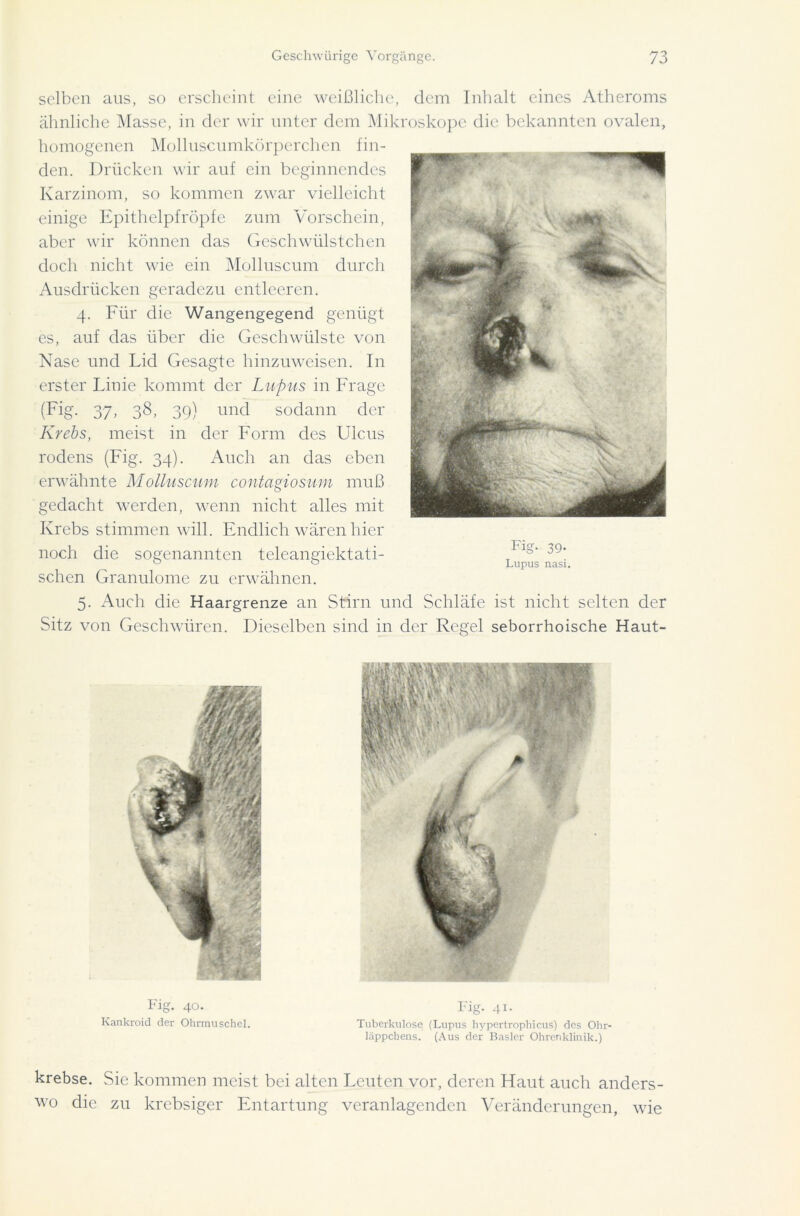 selben aus, so erscheint eine weißliche, dem Inhalt eines Atheroms ähnliche Masse, in der wir unter dem Mikroskope die bekannten ovalen, homogenen Molluscumkörperchen fin- den. Drücken wir auf ein beginnendes Karzinom, so kommen zwar vielleicht einige Epithelpfröpfe zum Vorschein, aber wir können das Gcschwülstchen doch nicht wie ein Molluscum durch Ausdrücken geradezu entleeren. 4. Für die Wangengegend genügt es, auf das über die Geschwülste von Nase und Lid Gesagte hinzuweisen. In erster Linie kommt der Lupus in Frage (Fig. 37, 38, 39) und sodann der Krebs, meist in der Form des Ulcus rodens (Fig. 34). Auch an das eben erwähnte Molluscum contagiosum muß gedacht werden, wenn nicht alles mit Krebs stimmen will. Endlich wären hier noch die sogenannten teleangiektati- schen Granulome zu erwähnen. 5. Auch die Haargrenze an Stirn und Schläfe ist nicht selten der Sitz von Geschwüren. Dieselben sind in der Regel seborrhoische Haut- Fig. 39- Lupus nasi. krebse. Sie kommen meist bei alten Leuten vor, deren Haut auch anders- wo die zu krcbsiger Entartung veranlagenden Veränderungen, wie