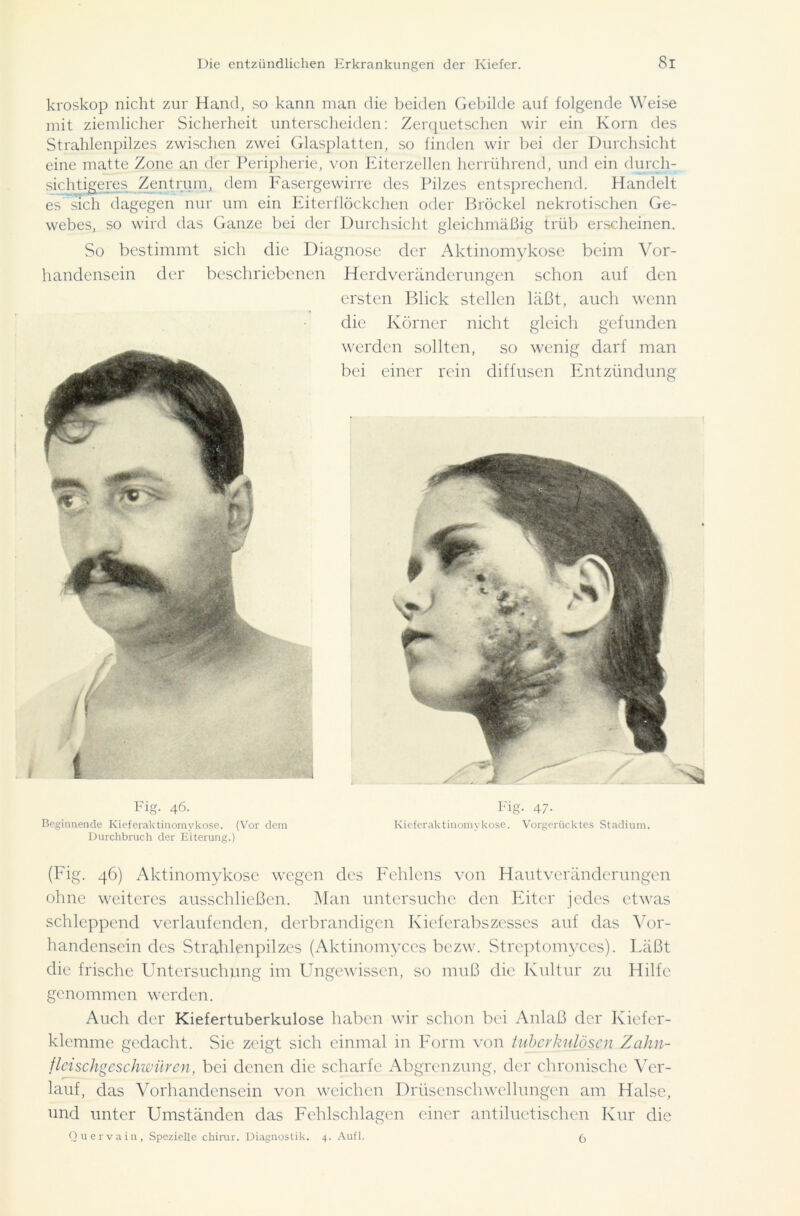 kroskop nicht zur Hand, so kann man die beiden Gebilde auf folgende Weise mit ziemlicher Sicherheit unterscheiden: Zerquetschen wir ein Korn des Strahlenpilzes zwischen zwei Glasplatten, so finden wir bei der Durchsicht eine matte Zone an der Peripherie, von Eiterzellen herrührend, und ein durch- sichtigeres Zentrum, dem Fasergewirre des Pilzes entsprechend. Handelt es sich dagegen nur um ein Eiterflöckchen oder Brockel nekrotischen Ge- webes, so wird das Ganze bei der Durchsicht gleichmäßig trüb erscheinen. So bestimmt sich die Diagnose der Aktinomykose beim Vor- handensein der beschriebenen i Herdveränderungen schon auf den ersten Blick stellen läßt, auch wenn die Körner nicht gleich gefunden werden sollten, so wenig darf man bei einer rein diffusen Entzündung Fig. 46. Beginnende Kieferaktinomykose. (Vor dem Durchbruch der Eiterung.) Fig- 47- Kieferaktinomykose. Vorgerücktes Stadium. (Fig. 46) Aktinomykose wegen des Fehlens von Haut Veränderungen ohne weiteres ausschließen. Man untersuche den Eiter jedes etwas schleppend verlaufenden, derbrandigen Kieferabszesses auf das Vor- handensein des Strahlenpilzes (Aktinomyces bezw. Streptomyces). Läßt die frische Untersuchung im Ungewissen, so muß die Kultur zu Hilfe genommen werden. Auch der Kiefertuberkulose haben wir schon bei Anlaß der Kiefer- klemme gedacht. Sie zeigt sich einmal in Form von tuberkulösen Zahn- fleischgeschwüren, bei denen die scharfe Abgrenzung, der chronische Ver- lauf, das Vorhandensein von weichen Drüsenschwellungen am Halse, und unter Umständen das Fehlschlagen einer antiluetischen Kur die Quervain, Spezielle chirur. Diagnostik. 4. Aufl. 6
