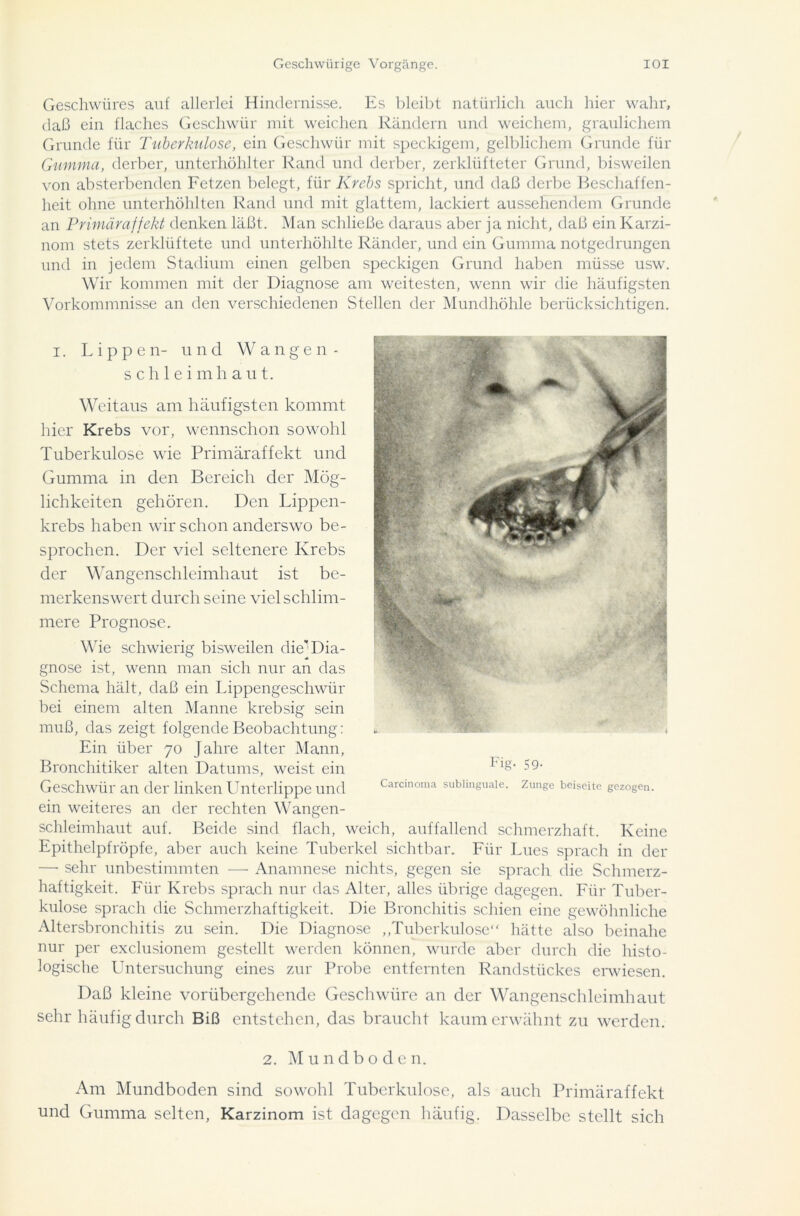 Geschwüres auf allerlei Hindernisse. Es bleibt natürlich auch hier wahr, daß ein flaches Geschwür mit weichen Rändern und weichem, graulichem Grunde für Tuberkulose, ein Geschwür mit speckigem, gelblichem Grunde für Gumma, derber, unterhöhlter Rand und derber, zerklüfteter Grund, bisweilen von absterbenden Fetzen belegt, für Krebs spricht, und daß derbe Beschaffen- heit ohne unterhöhlten Rand und mit glattem, lackiert aussehendem Grunde an Primäraffekt denken läßt. Man schließe daraus aber ja nicht, daß ein Karzi- nom stets zerklüftete und unterhöhlte Ränder, und ein Gumma notgedrungen und in jedem Stadium einen gelben speckigen Grund haben müsse usw. Wir kommen mit der Diagnose am weitesten, wenn wir die häufigsten Vorkommnisse an den verschiedenen Stellen der Mundhöhle berücksichtigen. Weitaus am häufigsten kommt hier Krebs vor, wennschon sowohl Tuberkulose wie Primäraffekt und Gumma in den Bereich der Mög- lichkeiten gehören. Den Lippen- krebs haben wir schon anderswo be- sprochen. Der viel seltenere Krebs der Wangenschleimhaut ist be- merkenswert durch seine viel schlim- mere Prognose. Wie schwierig bisweilen die'Dia- gnose ist, wenn man sich nur an das Schema hält, daß ein Lippengeschwür bei einem alten Manne krebsig sein muß, das zeigt folgende Beobachtung: Ein über 70 Jahre alter Mann, Bronchitiker alten Datums, weist ein Geschwür an der linken Unterlippe und ein weiteres an der rechten Wangen- schleimhaut auf. Beide sind flach, weich, auffallend schmerzhaft. Keine Epithelpfröpfe, aber auch keine Tuberkel sichtbar. Für Lues sprach in der —■ sehr unbestimmten — Anamnese nichts, gegen sie sprach die Schmerz- haftigkeit. Für Krebs sprach nur das Alter, alles übrige dagegen. Für Tuber- kulose sprach die Schmerzhaftigkeit. Die Bronchitis schien eine gewöhnliche Altersbronchitis zu sein. Die Diagnose „Tuberkulose“ hätte also beinahe nur per exclusionem gestellt werden können, wurde aber durch die histo- logische Untersuchung eines zur Probe entfernten Randstückes eiwiesen. Daß kleine vorübergehende Geschwüre an der Wangenschleimhaut sehr häufig durch Biß entstehen, das braucht kaum erwähnt zu werden. Fig- 59- Carcinoma sublinguale. Zunge beiseite gezogen. 2. Mundboden. Am Mundboden sind sowohl Tuberkulose, als auch Primäraffekt und Gumma selten, Karzinom ist dagegen häufig. Dasselbe stellt sich
