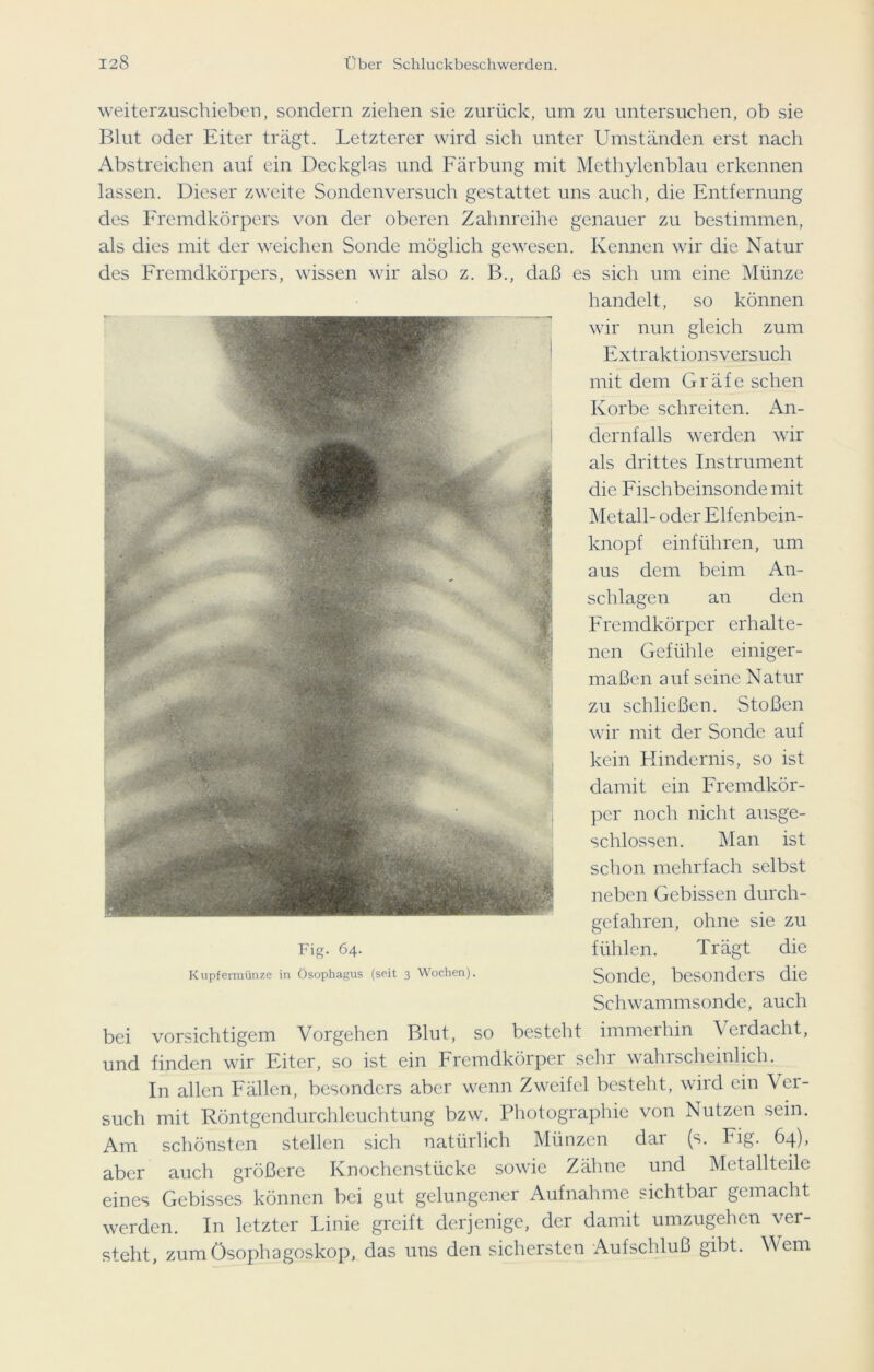 weiterzuschieben, sondern ziehen sie zurück, um zu untersuchen, ob sie Blut oder Eiter trägt. Letzterer wird sich unter Umständen erst nach Abstreichen auf ein Deckglas und Färbung mit Methylenblau erkennen lassen. Dieser zweite Sondenversuch gestattet uns auch, die Entfernung des Fremdkörpers von der oberen Zahnreihe genauer zu bestimmen, als dies mit der weichen Sonde möglich gewesen. Kennen wir die Natur des Fremdkörpers, wissen wir also z. B., daß es sich um eine Münze handelt, so können wir nun gleich zum Extraktionsversuch mit dem Gräfe sehen Korbe schreiten. An- dernfalls werden wir als drittes Instrument die Fischbeinsonde mit Metall- oder Elfenbein- knopf einführen, um aus dem beim An- schlägen an den Fremdkörper erhalte- nen Gefühle einiger- maßen auf seine Natur zu schließen. Stoßen wir mit der Sonde auf kein Hindernis, so ist damit ein Fremdkör- per noch nicht ausge- schlossen. Man ist schon mehrfach selbst neben Gebissen durch- gefa.hren, ohne sie zu fühlen. Trägt die Sonde, besonders die Schwammsonde, auch bei vorsichtigem Vorgehen Blut, so besteht immerhin \ eidacht, und finden wir Eiter, so ist ein Fremdkörper sehr wahrscheinlich. Fig. 64. Kupfermünze in Ösophagus (seit 3 Wochen). In allen Fällen, besonders aber wenn Zweifel besteht, wird ein Ver- such mit Röntgendurchleuchtung bzw. Photographie von Nutzen sein. Am schönsten stellen sich natürlich Münzen dar (s. Fig. 64), aber auch größere Knochenstücke sowie Zähne und Metallteile eines Gebisses können bei gut gelungener Aufnahme sichtbar gemacht werden. In letzter Linie greift derjenige, der damit umzugehen ver- steht, zumÖsophagoskop, das uns den sichersten Aufschluß gibt. Wem