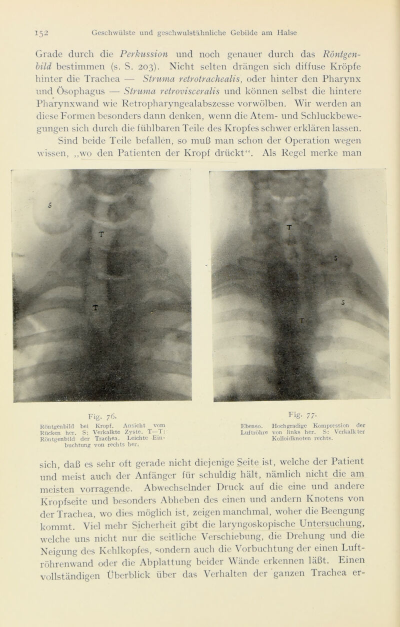 Grade durch die Perkussion und noch genauer durch das Röntgen- bild bestimmen (s. S. 203). Nicht selten drängen sich diffuse Kröpfe hinter die Trachea — Struma retrotrachealis, oder hinter den Pharynx und Ösophagus — Struma retrovisceralis und können selbst die hintere Pharynxwand wie Retropharyngealabszesse vor wölben. Wir werden an diese Formen besonders dann denken, wenn die Atem- und Schluckbewe- gungen sich durch die fühlbaren Teile des Kropfes schwer erklären lassen. Sind beide Teile befallen, so muß man schon der Operation wegen wissen, „wo den Patienten der Kropf drückt“. Als Regel merke man T $ Fig. 76. Röntgenbild bei Kropf. Ansicht vom Rücken her. S: Verkalkte Zyste. T— T: Röntgenbild der Trachea. Leichte Ein- buchtung von rechts her. Fig- 77- Ebenso. Hochgradige Kompression der Luftröhre von links her. S: Verkalkter Kolloidknoten rechts. sich, daß es sehr oft gerade nicht diejenige Seite ist, welche der Patient und meist auch der Anfänger für schuldig hält, nämlich nicht die am meisten vorragendc. Abwechselnder Diuck auf die eine und andere Kropfseite und besonders Abheben des einen und andern Knotens von der Trachea, wo dies möglich ist, zeigen manchmal, woher die Beengung kommt. Viel mehr Sicherheit gibt die laryngoskopische Untersuchung, welche uns nicht nur die seitliche Verschiebung, die Drehung und die Neigung des Kehlkopfes, sondern auch die Vorbuchtung der einen Luft- röhrenwand oder die Abplattung beider Wände erkennen läßt. Einen vollständigen Überblick über das Verhalten der ganzen Trachea er-