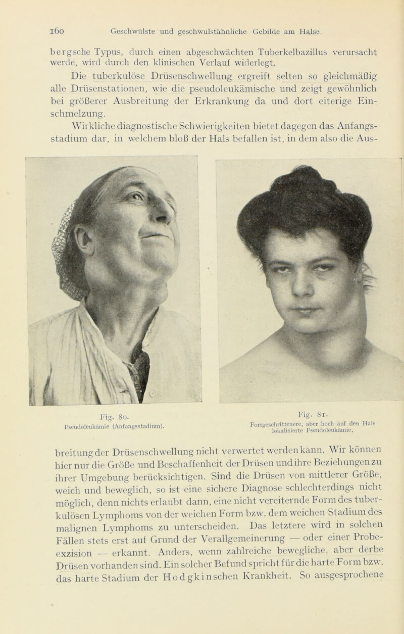 bergsche Typus, durch einen abgeschwächten Tuberkelbazillus verursacht werde, wird durch den klinischen Verlauf widerlegt. Die tuberkulöse Drüsenschwellung ergreift selten so gleichmäßig alle Drüsenstationen, wie die pseudoleukämische und zeigt gewöhnlich bei größerer Ausbreitung der Erkrankung da und dort eiterige Ein- schmelzung. Wirkliche diagnostische Schwierigkeiten bietet dagegen das Anfangs- stadium dar, in welchem bloß der Hals befallen ist, in dem also die Aus- Fig. 80. Pseudoleukämie (Anfangsstadium). Fig. 8l. Fortgeschrittenere, aber hoch auf den Hals lokalisierte Pseudoleukämie. breitungder Drüsenschwellung nicht verwertet werden kann. Wir können hier nur die Größe und Beschaffenheit der Drüsen und ihre Beziehungen zu ihrer Umgebung berücksichtigen. Sind die Drüsen von mittlerer Größe, weich und beweglich, so ist eine sichere Diagnose schlechterdings nicht möglich, denn nichts erlaubt dann, eine nicht vereiternde Form des tuber- kulösen Lymphoms von der weichen Form bzw. dem weichen Stadium des malignen Lymphoms zu unterscheiden. Das letzteie wird in solchen Fällen stets erst aut Grund der Verallgemeinerung — oder einer Probe- exzision — erkannt. Anders, wenn zahlreiche bewegliche, aber derbe Drüsen vorhanden sind. Ein solcher Befund spricht für die harte Form bzw. das harte Stadium der Hodgkinschen Krankheit. So ausgespiochtne