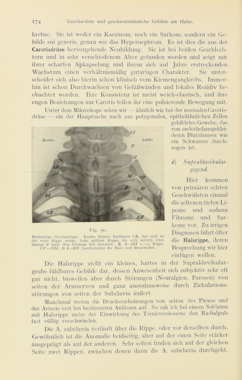 krebse. Sie ist weder ein Karzinom, noch ein Sarkom, sondern ein Ge- bilde sui generis, genau wie das Hypernephrom. Es ist dies die aus der Carotisdrüse hervorgehende Neubildung. Sie ist bei beiden Geschlech- tern und in sehr verschiedenem Alter gefunden worden und zeigt mit ihrer scharfen Apkapselung und ihrem sich auf Jahre erstreckenden Wachstum einen verhältnismäßig gutartigen Charakter. Sie unter- scheidet sich also hierin schon klinisch vom Kiemengangkrebs. Immer- hin ist schon Durchwachsen von Gefäßwänden und lokales Rezidiv be- obachtet worden. Ihre Konsistenz ist meist weich-elastisch, und ihre engen Beziehungen zur Carotis teilen ihr eine pulsierende Bewegung mit. Unter dem Mikroskope sehen wir — ähnlich wie bei der normalen Carotis- epithelähnlichen Zellen gebildetes Gewebe, das von endo thelausgeklei- deten Bluträumen wie ein Schwamm durch- zogen ist. d) Supraklavikulär- gegen d. Hier kommen von primären echten Geschwülsten einmal die seltenen tiefen Li- pome und sodann Fibrome und Sar- kome vor. Zu irrigen Diagnosen führt öfter die Halsrippe, deren Besprechung wir hier einfügen wollen, der Supraklavikular- grubc fühlbares Gebilde dar, dessen Anwesenheit sich subjektiv sehr oft gar nicht, bisweilen aber durch Störungen (Neuralgien, Paresen) von seiten der Armnerven und ganz ausnahmsweise durch Zirkulations- störungen von seiten der Subclavia äußert. Manchmal treten die Druckerscheinungen von seiten des Plexus und der Arterie erst bei bestimmten Anlässen auf. So sah ich hei einem Soldaten mit Halsrippe unter der Einwirkung des Tornisterriemens den Radialpuls fast völlig verschwinden. Die A. subclavia verläuft über die Rippe, oder vor derselben durch. Gewöhnlich ist die Anomalie beidseitig, aber auf der einen Seite stärker ausgeprägt als auf der anderen. Sehr selten finden sich auf der gleichen Seite zwei Rippen, zwischen denen dann die A. subclavia durchgeht. drüse — ein der Hauptsache nach aus polygonalen, 14 Rechts. ■ Links. UI CR 1 ' Ii! CR. LU % R RI R.n KR ,, '3 -.L. Rjn c -r T ' üJteL rjr Fig. 90- Beidseitige Cervikalrippe. Rechts kleines Rudiment CR, das sich an die erste Rippe anlegt, links größere Rippe, die sich mittels einer Spange S nach dem Sternum hin fortsetzt. R. I—III i.—3- Rippe. CV — VII, D I—III Querfortsätze, der Hals- und Brustwirbel. Die Halsrippe stellt ein kleines, hartes in