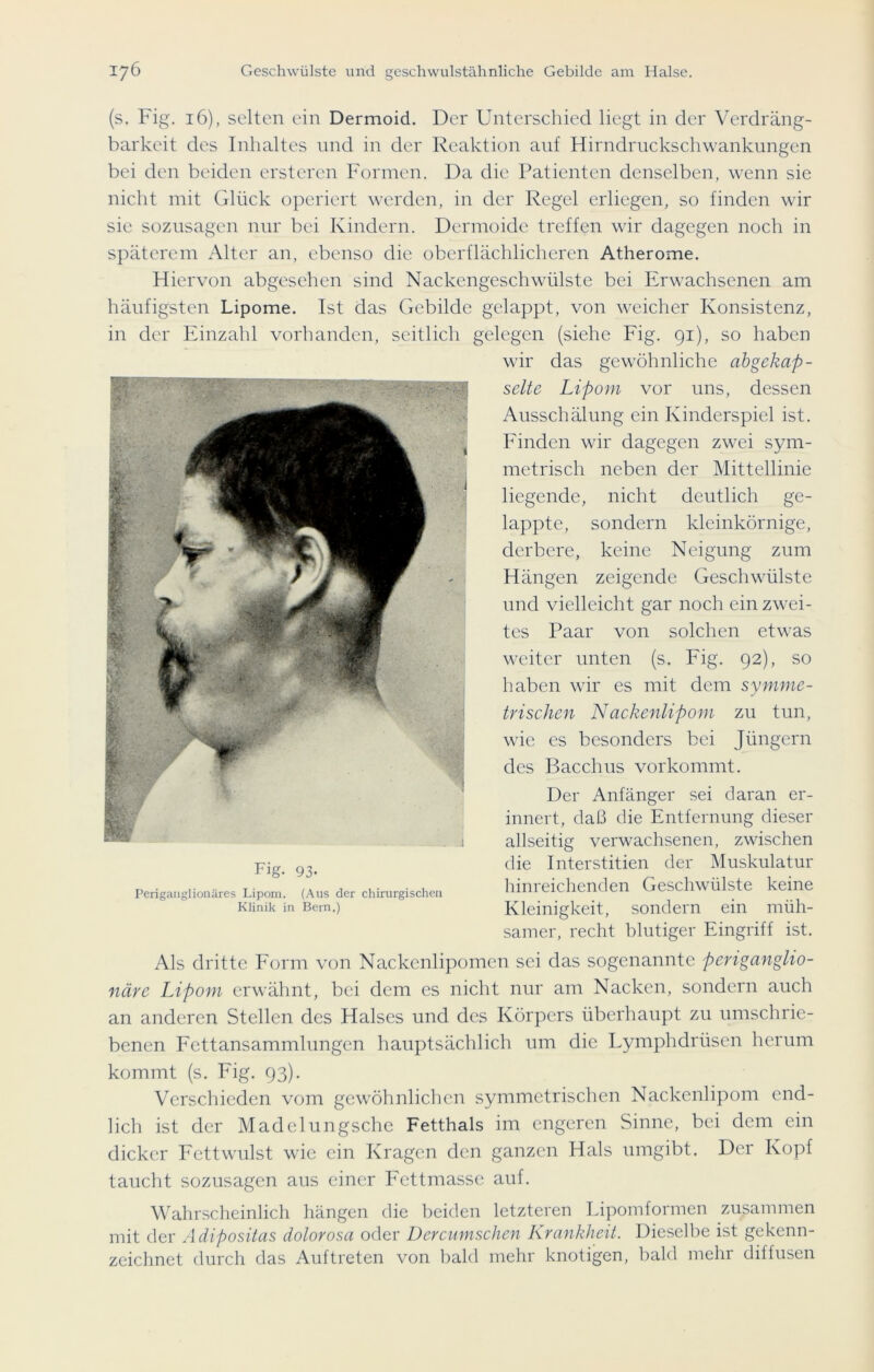 (s. Fig. 16), selten ein Dermoid. Der Unterschied liegt in der Verdräng- barkeit des Inhaltes und in der Reaktion auf Hirndruckschwankungen bei den beiden erstercn Formen. Da die Patienten denselben, wenn sie nicht mit Glück operiert werden, in der Regel erliegen, so finden wir sie sozusagen nur bei Kindern. Dermoide treffen wir dagegen noch in späterem Alter an, ebenso die oberflächlicheren Atherome. Hiervon abgesehen sind Nackengeschwülste bei Erwachsenen am häufigsten Lipome. Ist das Gebilde gelappt, von weicher Konsistenz, in der Einzahl vorhanden, seitlich gelegen (siehe Fig. 91), so haben wir das gewöhnliche abgekap- selte Lipom vor uns, dessen Ausschälung ein Kinderspiel ist. Finden wir dagegen zwei sym- metrisch neben der Mittellinie liegende, nicht deutlich ge- lappte, sondern kleinkörnige, derbere, keine Neigung zum Hängen zeigende Geschwülste und vielleicht gar noch ein zwei- tes Paar von solchen etwas weiter unten (s. Fig. 92), so haben wir es mit dem symme- trischen Nackenlipom zu tun, wie es besonders bei Jüngern des Bacchus vorkommt. Der Anfänger sei daran er- innert, daß die Entfernung dieser allseitig verwachsenen, zwischen die Interstitien der Muskulatur hinreichenden Geschwülste keine Kleinigkeit, sondern ein müh- samer, recht blutiger Eingriff ist. Als dritte Form von Nackenlipomen sei das sogenannte periganglio- näre Lipom erwähnt, bei dem es nicht nur am Nacken, sondern auch an anderen Stellen des Halses und des Körpers überhaupt zu umschrie- benen Fcttansammlnngen hauptsächlich um die Lymphdrüsen herum kommt (s. Fig. 93). Verschieden vom gewöhnlichen symmetrischen Nackenlipom end- lich ist der Madelungsche Fetthals im engeren Sinne, bei dem ein dicker Fettwulst wie ein Kragen den ganzen Hals umgibt. Der Kopf taucht sozusagen aus einer Fettmasse auf. Wahrscheinlich hängen die beiden letzteren Lipomformen zusammen mit der Adipositas dolorosa oder Dercumschen Krankheit. Dieselbe ist gekenn- zeichnet durch das Auftreten von bald mehr knotigen, bald mehr dillusen Fig- 93- Perigauglionäres Lipom. (Aus der chirurgischen Klinik in Bern.)