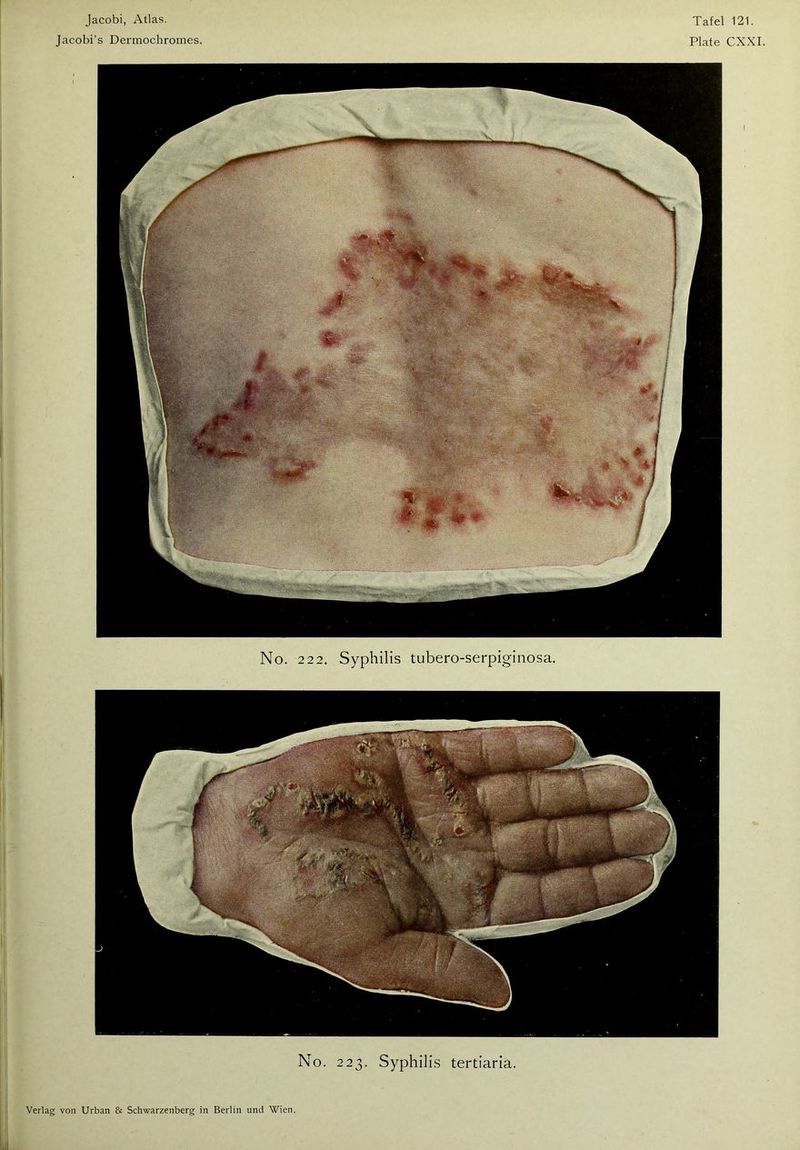 Jacobi’s Dermochromes. Plate CXXI. Verlag von Urban & Schwarzenberg in Berlin und Wien. No. 222. Syphilis tubero-serpiginosa.