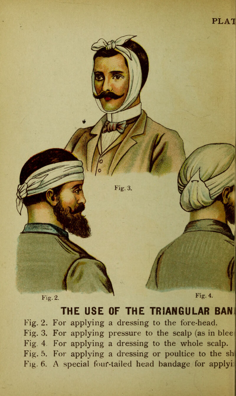 PLAll THE USE OF THE TRIANGULAR BAN Fig. 2. For applying a dressing to the fore-head. F‘ig. 3. For applying pressure to the scalp (as in blee Fig, 4 For applying a dressing to the whole scalp. Fig. 5. For applying a dressing or poultice to the sh