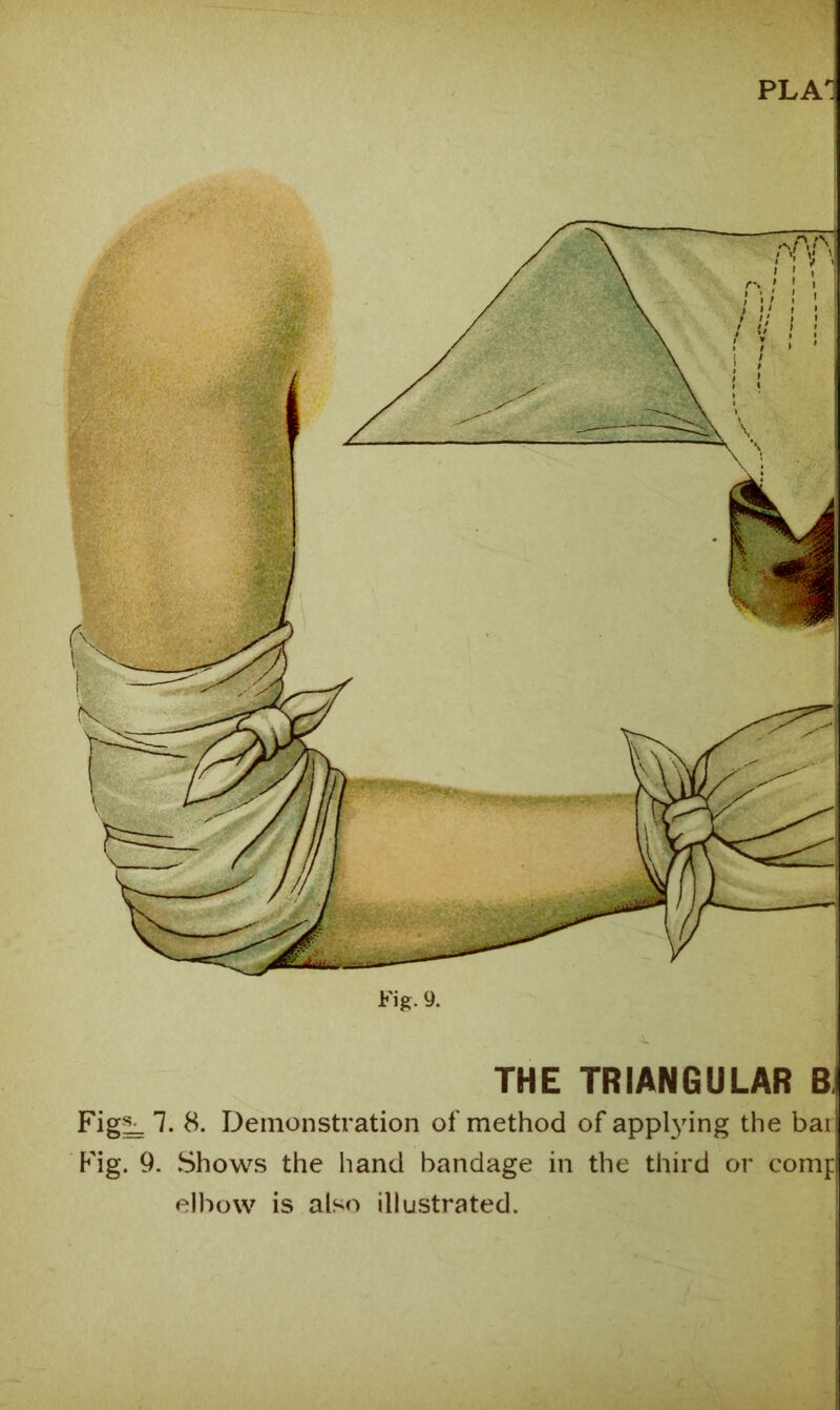 THE TRIANGULAR B. Fig^ 7. 8. Demonstration of method of appl3nng the bar Fig. 9. Shows the hand bandage in the third or comp ell'row is also illustrated.