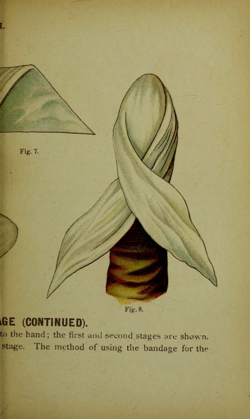 iGE (CONTINUED). to the hand; the first and second stages are shown. stag;e. The method of using the bandage for the