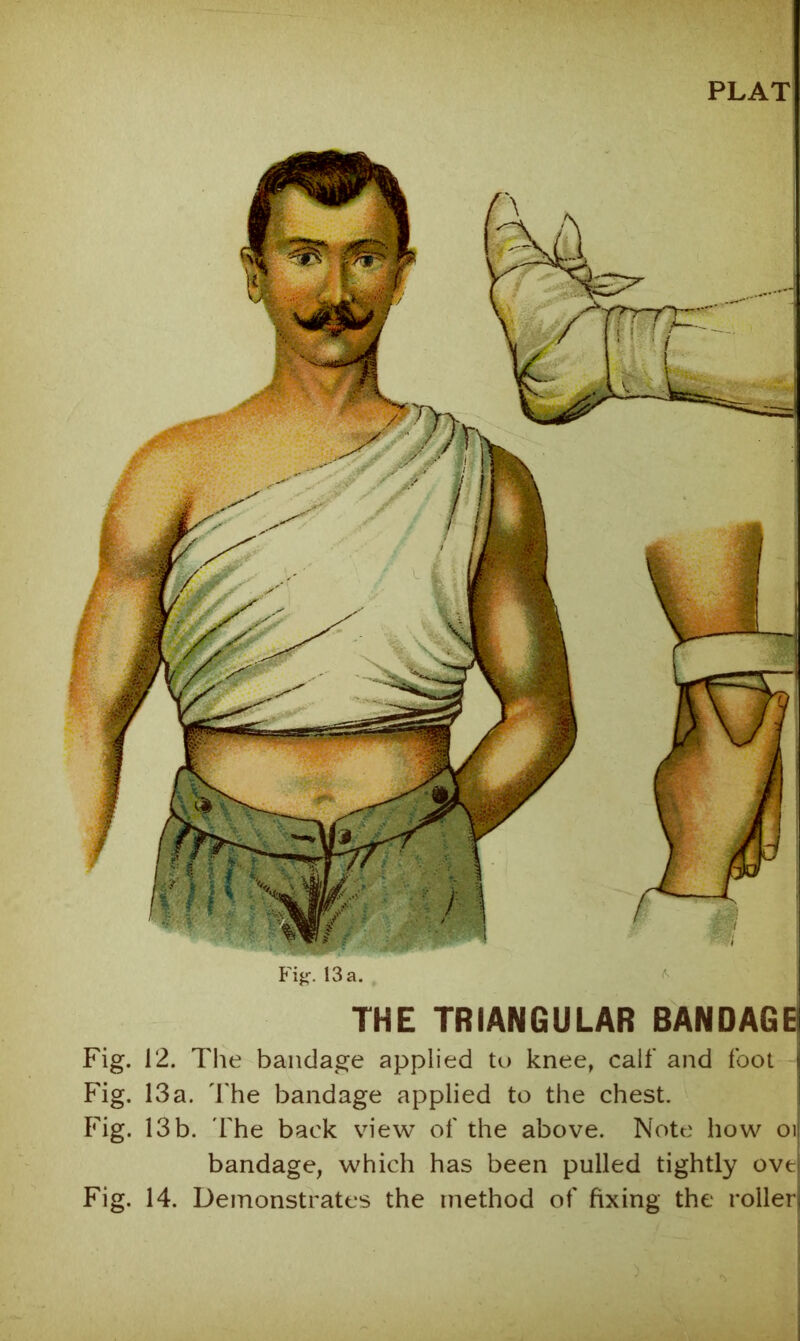 PLAT Fij;;-. 13 a. THE TRIANGULAR BANDAGE Fig. 12. The bandage applied to knee, calf and foot j Fig. 13a. The bandage applied to the chest. i Fig. 13 b. fhe back view of the above. Note how oij bandage, which has been pulled tightly ove| Fig. 14. Demonstrates the method of fixing the roller!