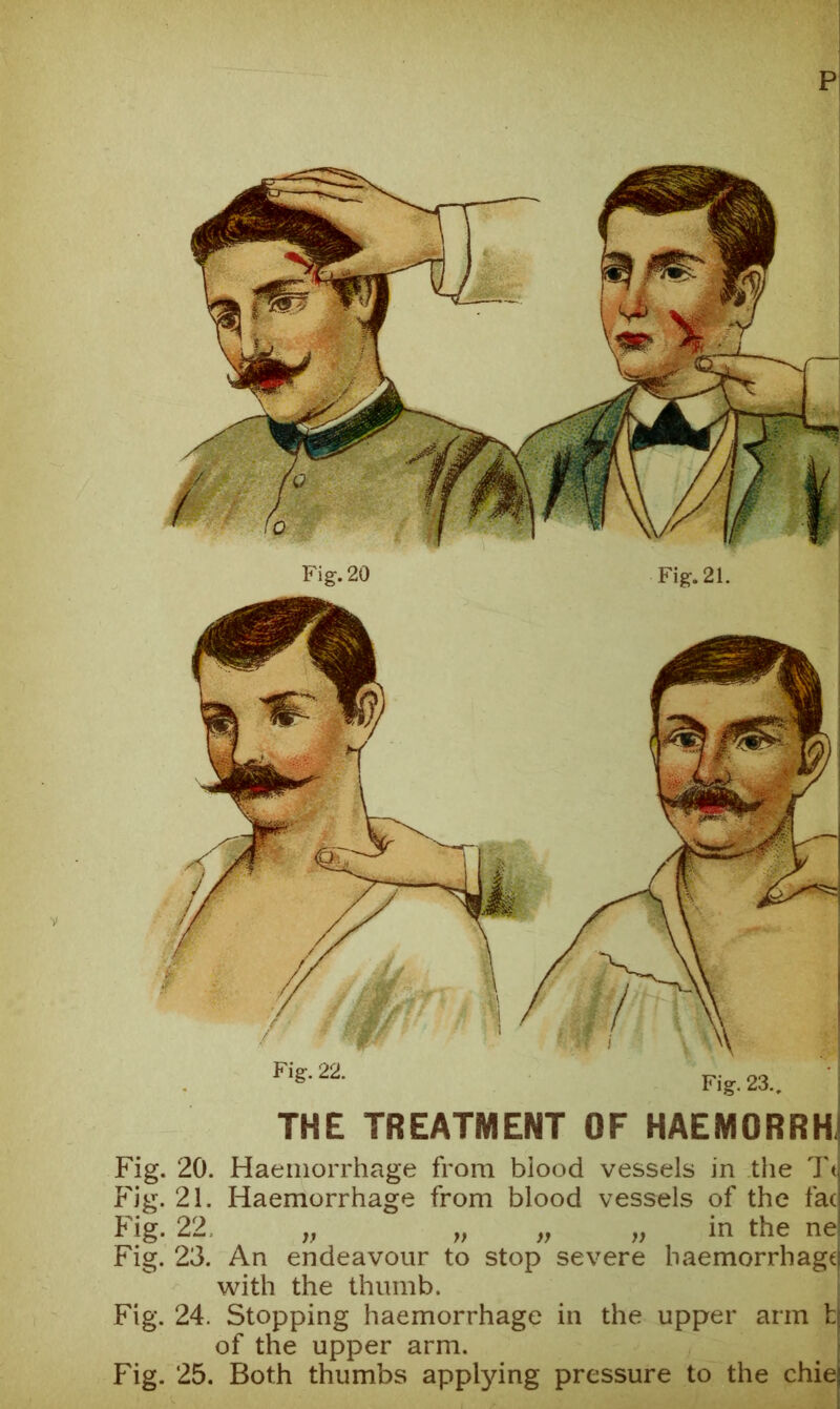 THE TREATMENT OF HAEMORRH, Fig. 20. Haemorrhage from blood vessels in the Tt P'ig. 21. Haemorrhage from blood vessels of the fac Fig. 22. „ „ „ „ in the ne Fig. 23. An endeavour to stop severe haemorrhage with the thumb. Fig. 24. Stopping haemorrhage in the upper arm h of the upper arm. Fig. 25. Both thumbs applying pressure to the chie