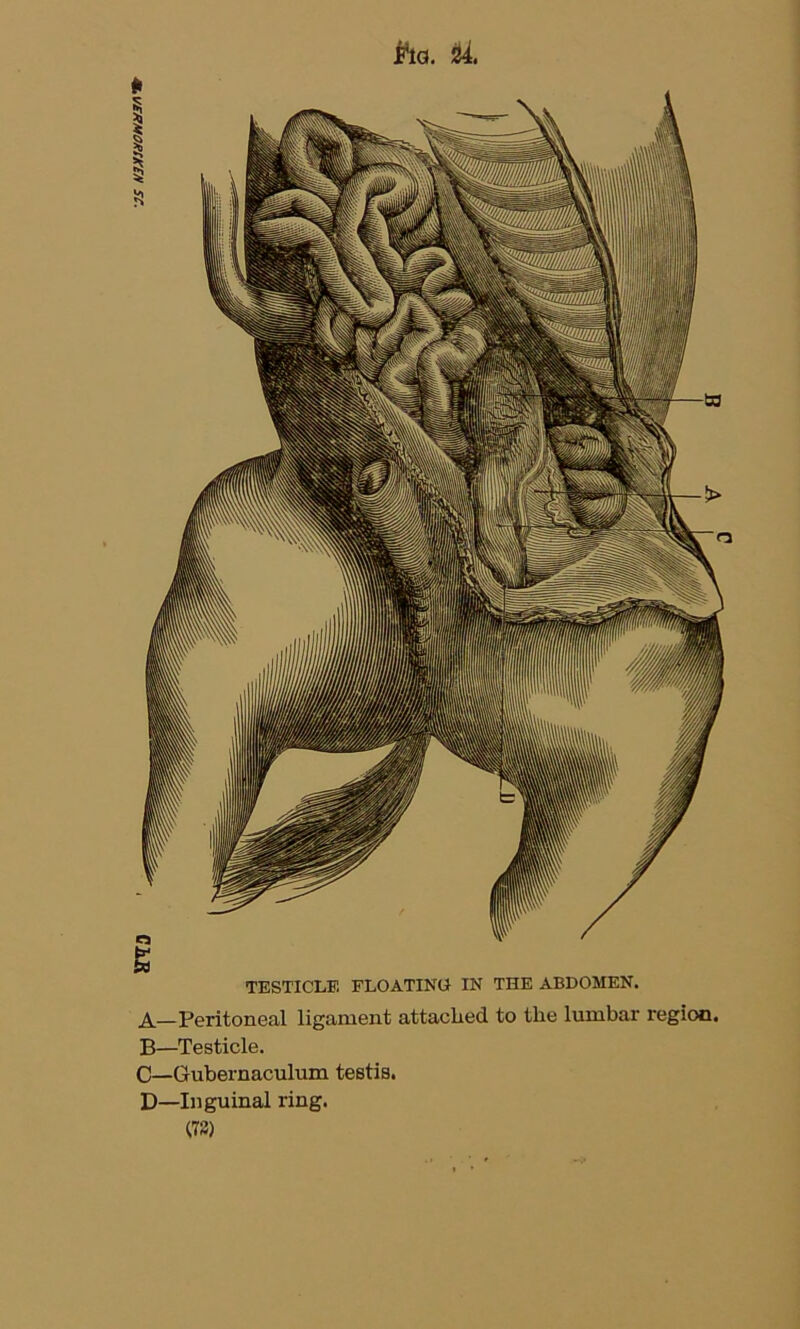 /ERMOMKEN SC. fta. Hi. £ TESTICLE FLOATING IN THE ABDOMEN. A—Peritoneal ligament attached to the lumbar region. B—Testicle. C—Gubernaculum testis. D—Inguinal ring. 178)