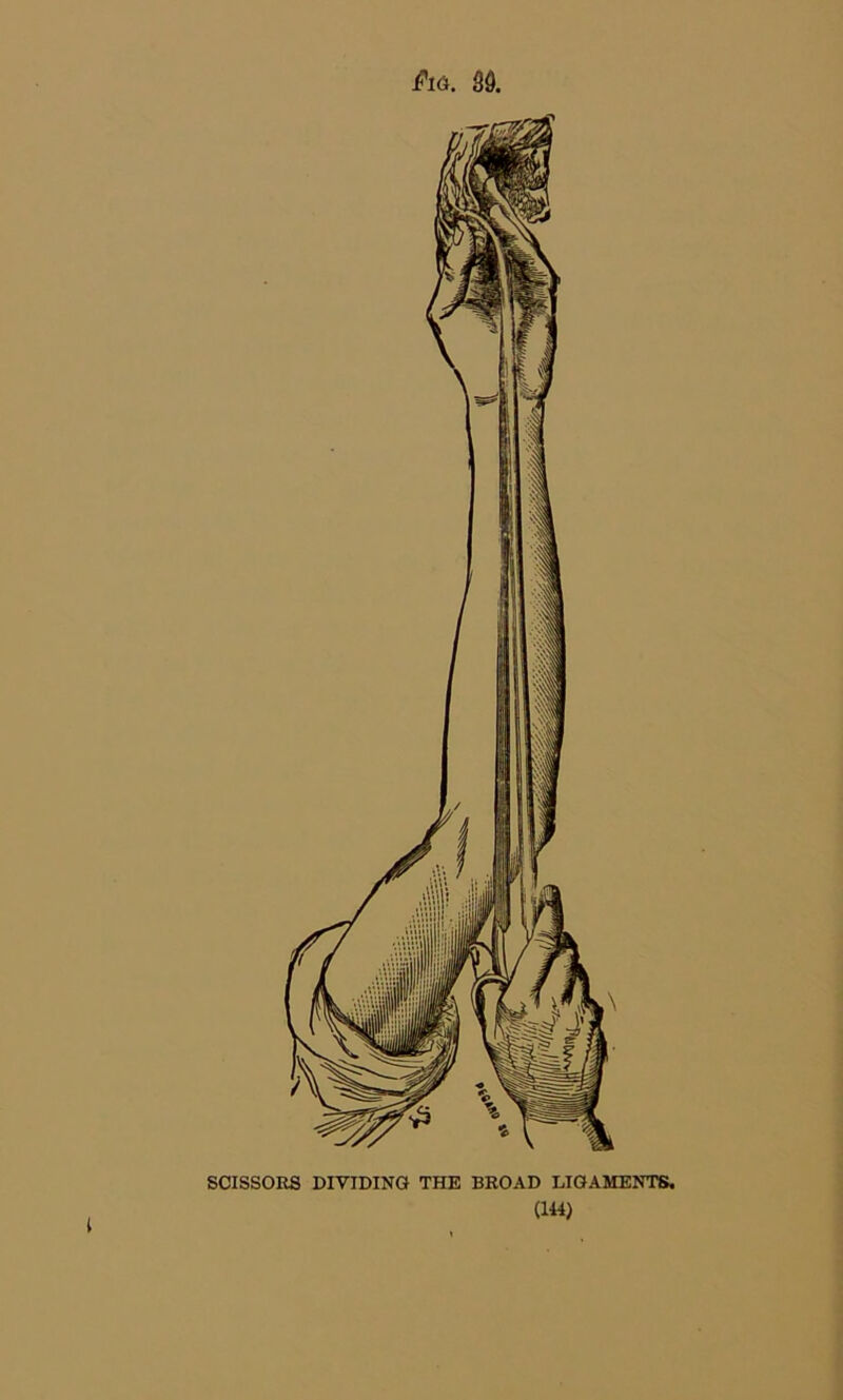 i SCISSORS DIVIDING THE BROAD LIGAMENTS.