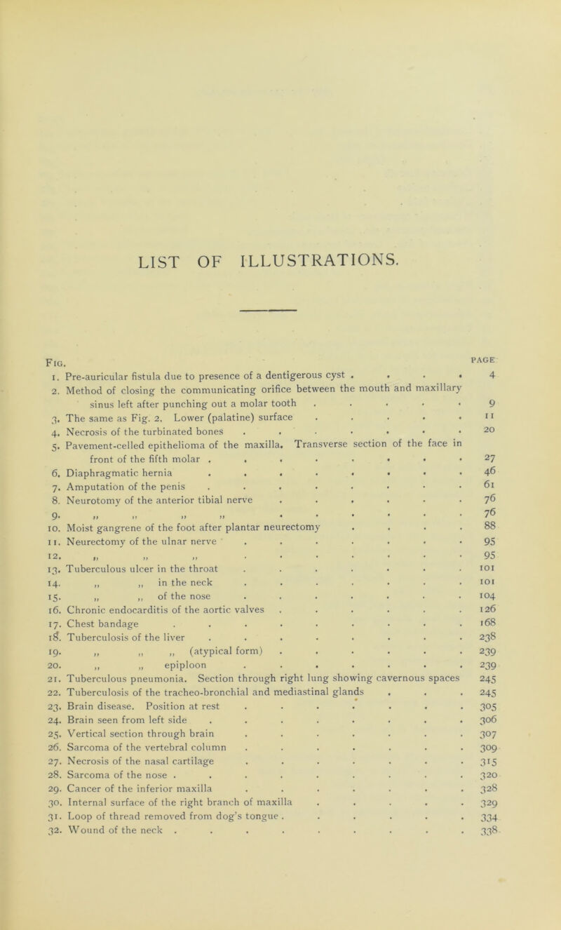 LIST OF ILLUSTRATIONS. Fig 1. 2. 3* 4- 5- 6. 7- 8. 9- 10. 11. 12. Cl- 14. i5- 16. 17- 1$. 19. 20. 21. 22. 23- 24. 25- 26. 27. 28. 29. 30. 3i- 32. Pre-auricular fistula due to presence of a dentigerous cyst . . . • Method of closing the communicating orifice between the mouth and maxillar) sinus left after punching out a molar tooth The same as P'ig. 2. Lovver (palatine) surface Necrosis of the turbinated bones Pavement-celled epithelioma of the maxilla front of the fifth molar , . Diaphragmatic hernia Amputation of the pénis Neurotomy of the anterior tibial nerve Moist gangrené of the foot after plantar neu Neurectomy of the ulnar nerve Trai rectomy sverse section Tuberculous ulcer in the throat „ ,, in the neck „ ,, of the nose Chronic endocarditis of the aortic valves Chest bandage Tuberculosis of the liver „ „ „ (atypical form) „ „ épiploon Tuberculous pneumonia. Section through right lung showing cavernous Tuberculosis of the tracheo-bronchial and médiastinal glands m Brain disease. Position at rest Brain seen from left side Vertical section through brain Sarcoma of the vertébral column Necrosis of the nasal cartilage Sarcoma of the nose . Cancer of the inferior maxilla Internai surface of the right branch of maxilla Loop of thread removed from dog’s tongue . Wound of the neck .... of the face in spaces PAGE 4 9 11 20 27 46 61 76 76 88 95 95 101 101 104 126 168 238 239 239 245 245 305 306 307 309 3i5 320 328 329 334 338