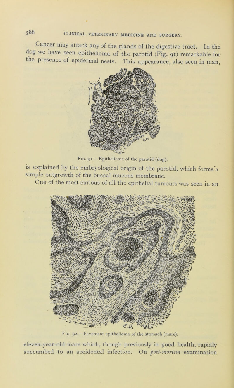 Cancer may attack any of the glands of the digestive tract. In the dog we hâve seen epithelioma of the parotid (Fig. 91) remarkable for the presence of epidermal nests. This appearance, also seen in man, Fig. 91. —Epithelioma of the parotid (dog). is explained by the embryological origin of the parotid, which forms'a simple outgrowth of the buccal mucous membrane. One of the most curious of ail the épithélial tumours was seen in an Fig. 92.— Pavement epithelioma of the stomach (mare). eleven-year-old mare which, though previously in good health, rapidly succumbed to an accidentai infection. On post-mortem examination