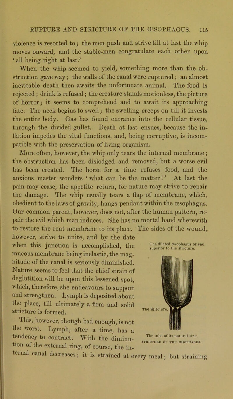 violence is resorted to; the men push and strive till at last the whip moves onward^ and the stable-men congratulate each other upon ‘ all being right at last/ When the whip seemed to yield, something more than the ob- struction gave way; the walls of the canal were ruptured; an almost inevitable death then awaits the unfortunate animal. The food is rejected; drink is refused; the creature stands motionless, the picture of horror; it seems to compreheud and to await its approaching fate. The neck begins to swell; the swelling creeps on till it invests the entire body. Gas has found entrance into the cellular tissue, through the divided gullet. Death at last ensues, because the in- flation impedes the vital functions, and, being corruptive, is incom- patible with the preservation of living organism. More often, however, the whip only tears the internal membrane; the obstruction has been dislodged and removed, but a worse evil has been created. The horse for a time refuses food, and the anxious master wonders ‘ what can be the matter! * At last the pain maj' cease, the appetite return, for nature may strive to repair the damage. The whip usually tears a flap of membrane, which, obedient to the laws of gravity, hangs pendant within the oesophagus. Our common parent, however, does not, after the human pattern, re- pair the evil which man induces. She has no mortal hand wherewith to restore the rent membrane to its place. The sides of the wound, however, strive to unite, and by the date when this junction is accomplished, the mucous membrane being inelastic, the mag- nitude of the calial is seriously diminished. Nature seems to feel that the chief strain of deglutition will be upon this lessened spot, which, therefore, she endeavours to support and strengthen. Lymph is deposited about the place, till ultimately a firm and solid stricture is formed, This, however, though bad enough, is not the worst. Lymph, after a time, has a tendency to contract. With the diminu- tion of the external ring, of course, the in- ternal canal decreases; it is strained at every meal; but straining iTic dilated oesophagus or sac superior to the striciure. The Stricture. The tube of its natural sizE. STRICTURE OF THE (ESOPHAGUS.