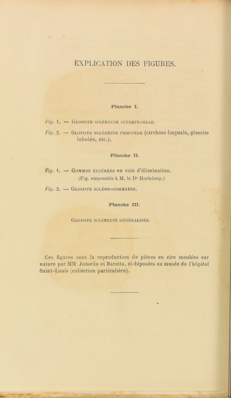 EXPLICATION DES FIGURES. Planche I. Fi IJ. 1. — Glossite scléreuse superficielle. Fig. ± — Glossite scléreuse profonde (cirrhose linguale, glossite lobulée, etc.). Planche II. Fig. t. — Gommes ulcérées en voie d’élimination. . (Fig. empruntée à M. le D1' Horteloup.) Fig. <2. — Glossite scléro-gommeuse. Planche III. Glossite scléreuse généralisée. Ces figures sont la reproduction de pièces en cire moulées sur nature par MM Jumelin et Baretta, et déposées au musée de l’hôpital Saint-Louis (collection particulière).