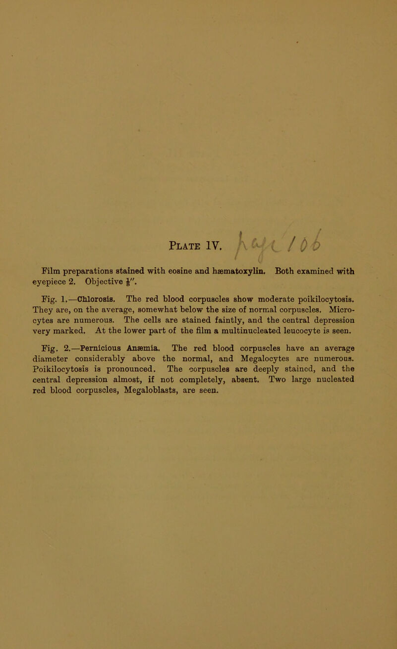 kui fbl < t Film preparations stained with eosine and haematoxylin. Both examined with eyepiece 2. Objective Fig. 1.—Chlorosis. The red blood corpuscles show moderate poikilocytosis. They are, on the average, somewhat below the size of normal corpuscles. Micro- cytes are numerous. The cells are stained faintly, and the central depression very marked. At the lower part of the film a multinucleated leucocyte is seen. Fig. 2.—Pernicious Anaemia. The red blood corpuscles have an average diameter considerably above the normal, and Megalocytes are numerous. Poikilocytosis is pronounced. The corpuscles are deeply stained, and the central depression almost, if not completely, absent. Two large nucleated red blood corpuscles, Megaloblasts, are seen.