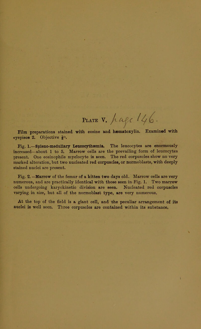 Film preparations stained with eosine and hsematoxylin. Examined with eyepiece 2. Objective Fig. 1.—Spleno-medullary Leucocythsemia. The leucocytes are enormously increased—about 1 to 5. Marrow cells are the prevailing form of leucocytes present. One eosinophile myelocyte is seen. The red corpuscles show no very marked alteration, but two nucleated red corpuscles, or normoblasts, with deeply stained nuclei are present. Fig. 2. —Marrow of the femur of a kitten two days old. Marrow cells are very numerous, and are practically identical with those seen in Fig. 1. Two marrow cells undergoing karyokinetic division are seen. Nucleated red corpuscles varying in size, but all of the normoblast type, are very numerous. At the top of the field is a giant cell, and the peculiar arrangement of its nuclei is well seen. Three corpuscles are contained within its substance. i