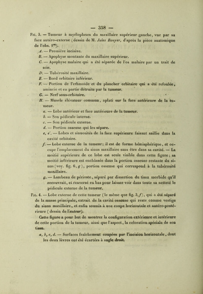 Fig. 3. —Tumeur à myéloplaxes du aiaxillaire supérieur gauche, vue par sa face antéro-cxterue ( dessiu de M. Jules Rouyerj d’après la pièce auatomique de l’obs. 1). A. — Première incisive. B. — Apophyse montante du maxillaire supérieur. C. — Apophyse malaire qui a été séparée de l’os malaire par un trait de scie, D. — Tubérosité maxillaire. E. — Bord orbitaire inférieur. F. — Portion de l’ethmoïde et du plancher orbitaire qui a été refoulée, amincie et en partie détruite par la tumeur. G. — Nerf sous-orbitaire. H. — Muscle élévateur commun, aplati sur la face antérieure de la tu- meur. a. — Lobe antérieur et face antérieure de la tumeur. b. — Son pédicule interne. c. — Son pédicule externe. d. — Portion osseuse qui les sépare. e. e\ — Lobes et sinuosités de la face supérieure faisant saillie dans la cavité orbitaire. f. — Lobe externe de la tumeur; il est de forme hémisphérique, et oc- cupe l’emplacement du sinus maxillaire sans être dans sa cavité. — La ' moitié supérieure de ce lobe est seule visible dans celte figure; sa moitié inférieure est enchâssée dans la portion osseuse restante du si- nus (voy. fig. 6, g), portion osseuse qui correspond à la tubérosité maxillaire. g. — Lambeau de périoste, séparé par dissection du tissu morbide qu’il recouvrait, et renversé en bas pour laisser voir dans toute sa netteté le pédicule externe de la tumeur. Fig. 4. — Lobe externe de cette tumeur ( le même que fig. 3,y), qui a été séparé de la masse principale, extrait de la cavité osseuse qui reste comme vestige du sinus maxillaire, et enfin soumis à une coupe horizontale et antéro-posté- rieure ( dessin de X'auteur). Cette figure a pour but de montrer la configuration extérieure et intérieure de cette portion de la tumeur, ainsi que l’aspect, la coloration spéciale de son tissu. a, b, c, d. — Surfaces fraîchement coupées par l’incision horizontale, dont les deux lèvres ont été écartées à angle droit.