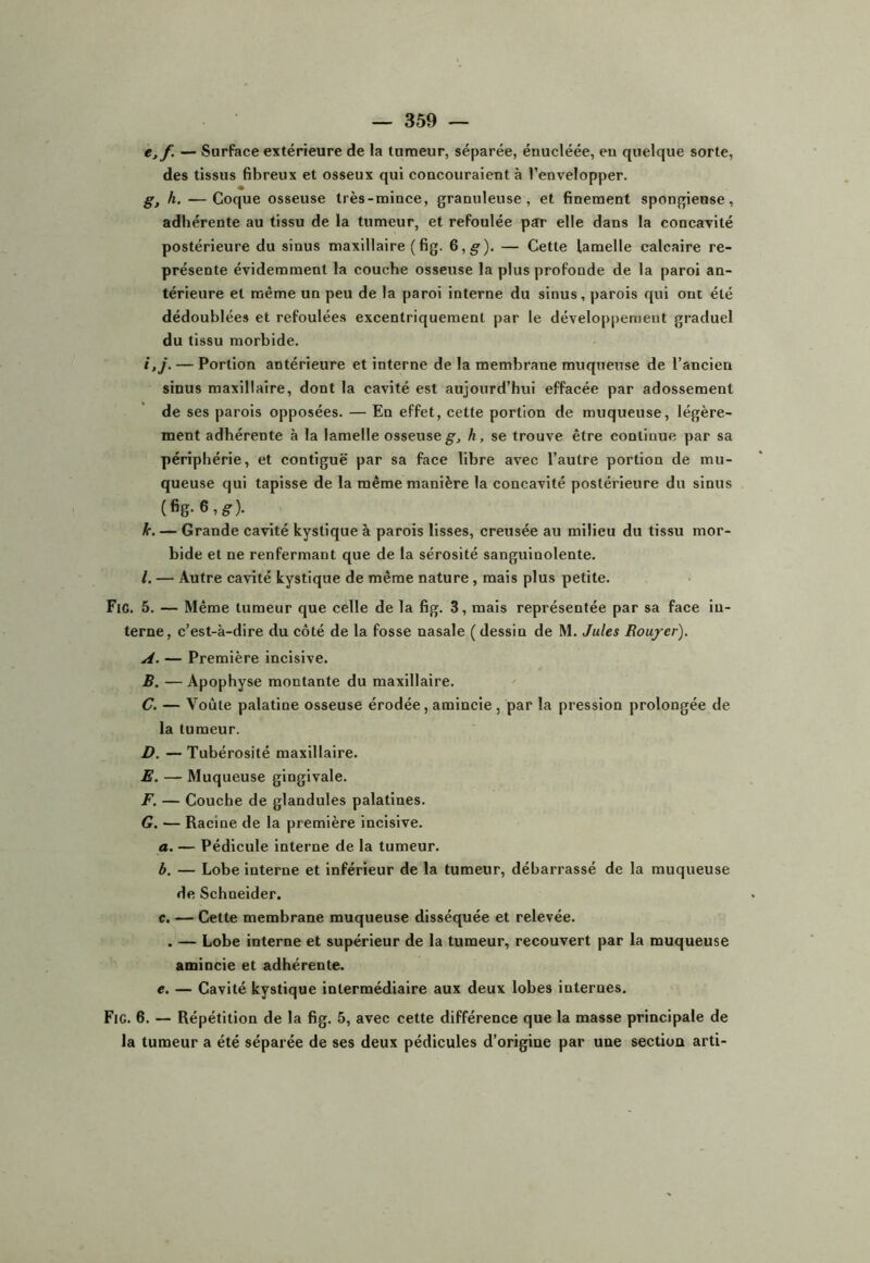 e,f. — Surface extérieure de la turaeur, séparée, énucléée, en quelque sorte, des tissus fibreux et osseux qui concouraient à l’envelopper. g, h, — Coque osseuse très-mince, granuleuse, et finement spongieuse, adhérente au tissu de la tumeur, et refoulée par elle dans la concavité postérieure du sinus maxillaire (fig. 6, g). — Cette lamelle calcaire re- présente évidemment la couche osseuse la plus profonde de la paroi an- térieure et même un peu de la paroi interne du sinus, parois qui ont été dédoublées et refoulées excentriquement par le développement graduel du tissu morbide. i,j. — Portion antérieure et interne de la membrane muqueuse de l’ancien sinus maxillaire, dont la cavité est aujourd’hui effacée par adossement de ses parois opposées. — En effet, cette portion de muqueuse, légère- ment adhérente à la lamelle osseuse g-, h, se trouve être continue par sa périphérie, et contiguë par sa face libre avec l’autre portion de mu- queuse qui tapisse de la même manière la concavité postérieure du sinus (fig- 6, g-). k. — Grande cavité kystique à parois lisses, creusée au milieu du tissu mor- bide et ne renfermant que de la sérosité sanguinolente. /. — Autre cavité kystique de même nature, mais plus petite. Fie. 5. — Même tumeur que celle de la fig. 3, mais représentée par sa face in- terne, c’est-à-dire du côté de la fosse nasale ( dessin de M. Jules Roujrer). A. — Première incisive. B. — Apophyse montante du maxillaire. C. — Voûte palatine osseuse érodée, amincie, par la pression prolongée de la tumeur. D. — Tubérosité maxillaire. E. — Muqueuse gingivale. F. — Couche de glandules palatines. G. — Racine de la première incisive. a. — Pédicule interne de la tumeur. b. — Lobe interne et inférieur de la tumeur, débarrassé de la muqueuse de Schneider. c. — Cette membrane muqueuse disséquée et relevée. . — Lobe interne et supérieur de la tumeur, recouvert par la muqueuse amincie et adhérente. e. — Cavité kystique intermédiaire aux deux lobes internes. Fig. 6. — Répétition de la fig. 5, avec cette différence que la masse principale de la tumeur a été séparée de ses deux pédicules d’origine par une section arti-