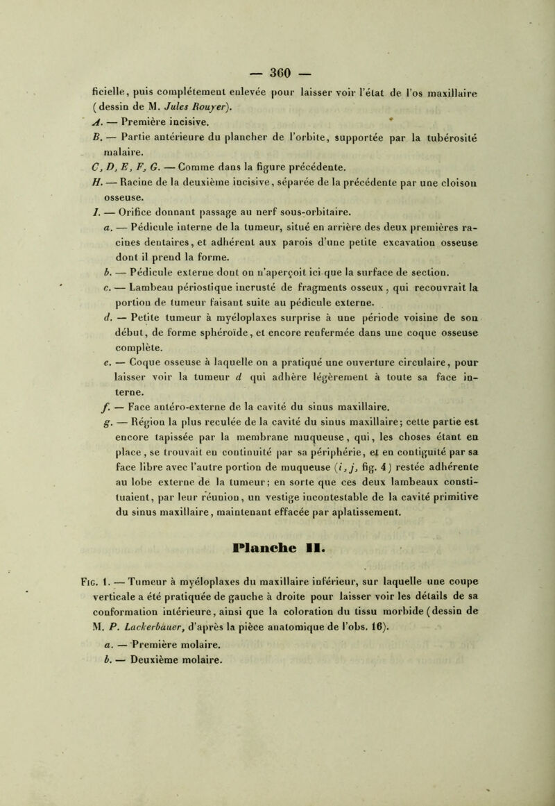 ficielle, puis coinpléteraeut enlevée pour laisser voir l’élat de l’os maxillaire (dessin de M. Jules Roujrer). A, — Première incisive. * B, — Partie antérieure du plancher de l’orbite, supportée par la tubérosité malaire. C, D, E, F J G. — Comme dans la figure précédente. H, — Racine de la deuxième incisive, séparée de la précédente par une cloison osseuse. J. — Orifice donnant passage au nerf sous-orbitaire. a. — Pédicule interne de la tumeur, situé en arrière des deux premières ra- cines dentaires, et adhérent aux parois d’une petite excavation osseuse dont il prend la forme. b. — Pédicule externe dont on n’aperçoit ici que la surface de section. c. — Lambeau périostique incrusté de fragments osseux , qui recouvrait la portion de tumeur faisant suite au pédicule externe. d. — Petite tumeur à myéloplaxes surprise à une période voisine de son début, de forme sphéroïde, et encore renfermée dans une coque osseuse complète. e. — Coque osseuse à laquelle on a pratiqué une ouverture circulaire, pour laisser voir la tumeur d qui adhère légèrement à toute sa face in- terne. y. — Face antéro-externe de la cavité du sinus maxillaire. g. — Région la plus reculée de la cavité du sinus maxillaire; cette partie est encore tapissée par la membrane muqueuse, qui, les choses étant en place , se trouvait en continuité par sa périphérie, et en contiguïté par sa face libre avec l’autre portion de muqueuse fig. 4) restée adhérente au lobe externe de la tumeur; en sorte que ces deux lambeaux consti- tuaient, par leur réunion, un vestige incontestable de la cavité primitive du sinus maxillaire, maintenant effacée par aplatissement. Planche 11. Fig. l. — Tumeur à myéloplaxes du maxillaire inférieur, sur laquelle une coupe verticale a été pratiquée de gauche à droite pour laisser voir les détails de sa conformation intérieure, ainsi que la coloration du tissu morbide (dessin de .M. P. Lackerbauer, d’après la pièce anatomique de l’obs. 16). a. — Première molaire. b. — Deuxième molaire.