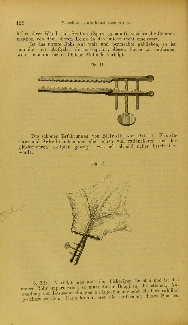 löthen ihrer Wände ein Septum (Sporn genannt), welches die Commu- nication von dem oberen Rohre in das untere recht erschwert. Ist das untere Rohr gut weit und permeabel geblieben, so ist nun die erste Aufgabe, dieses Septum, diesen Sporn zu entfernen, wenn man die bisher übliche Methode verfolgt. Fig. 11. Die schönen Erfahrungen von Billroth, von Dittel, Nicola- doni und Schede haben uns aber einen viel rationelleren und be- glückenderen Heilplan gezeigt, was ich alsbald näher beschreiben werde. Fig. 12. 8 563. Verfolgt man aber den bisherigen Curplan und ist das untere^ Rohr impermeabel, so muss durch Bougiren, In.iectionen, An- wendung von Brausemischungen zu Injectionen zuerst gj^.chert werden. Dann kommt erst die Entfernung dieses Spornes.