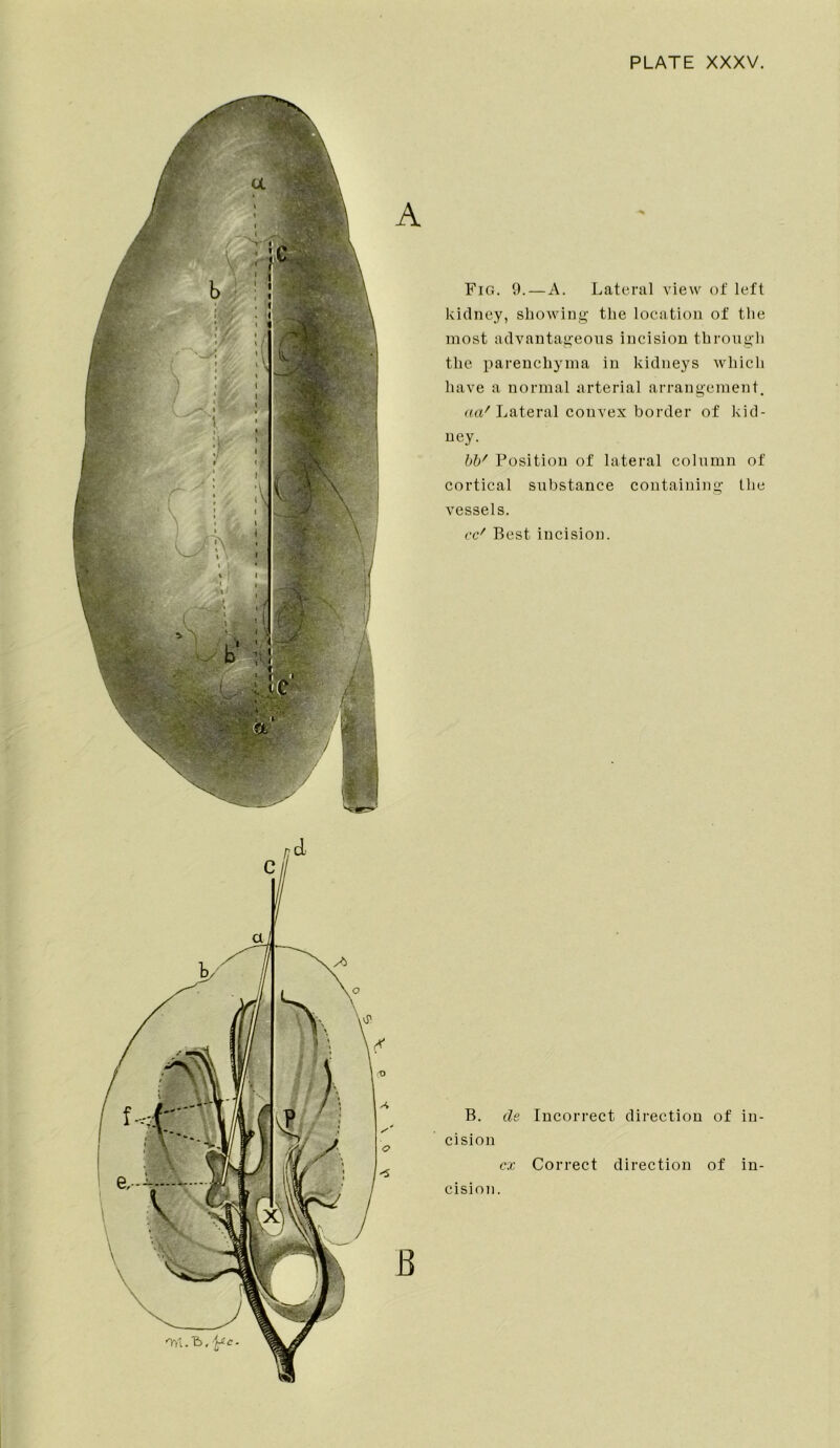 Fig. 9.—A. Lateral view of left kidney, showing the location of the most advantageous incision through the parenchyma in kidneys which have a normal arterial arrangement. aaf Lateral convex border of kid- ney. bb' Position of lateral column of cortical substance containing the vessels. cc' Best incision. 'Y/L.'b, jfe. B B. cle Incorrect direction of in- cision cx Correct direction of in- cision.