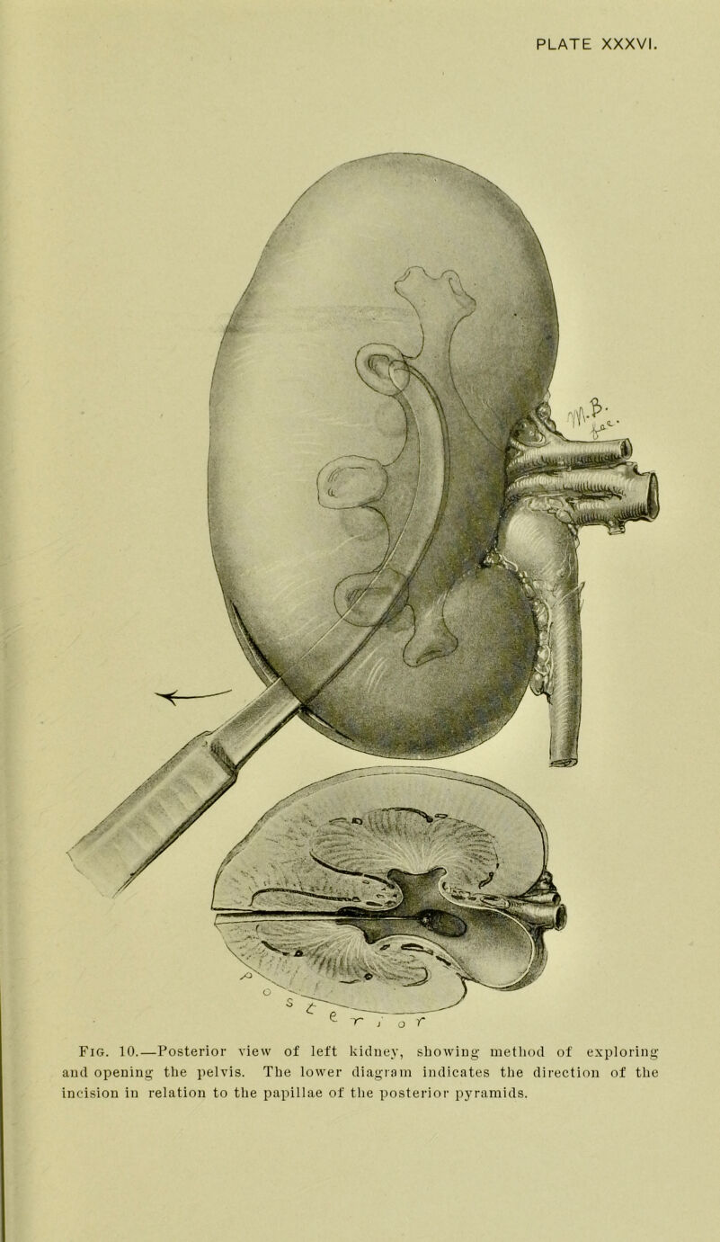 Fig. 10.—Posterior view of left kidney, showing method of exploring and opening the pelvis. The lower diagram indicates the direction of the incision in relation to the papillae of the posterior pyramids.