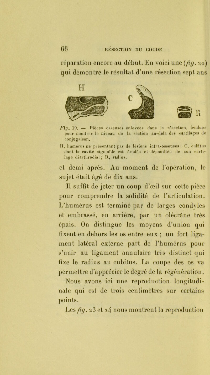réparation encore au début. En voici une {fi(j. 20) qui démontre le résultat d’une résection sept ans Fig. 19. — Pièces osseuses enlevées dans la résection, fendues pour montrer le niveau de la section au-delà des cartilas:es de conjugaison. II, liumérns ne présentant pas de lésions intra-osseuses ; C, cubitus dont la cavité sigmoïde est érodée et dépouillée «le son carti- lage diartlirodial ; R, radius, et demi après. Au moment de l’opération, le sujet était âgé de dix ans. Il sufbt de jeter un coup d’œil sur cette pièce pour comprendre la solidité de l’articulation. L’humérus est terminé [lar de larges condyles et embrassé, en arrière, par un olécrane très épais. On distingue les moyens d’union qui fixent en dehors les os entre eux ; un fort liga- ment latéral externe part de l’humérus pour s’unir au ligament annulaire très distinct qui fixe le radius au cubitus. La coupe des os va permettre d’apprécier le degré de la régénération. Nous avons ici une reproduction longitudi- nale qui est de trois centimètres sur certains points. Les fig. 2.3 et 24 nous montrent la rejiroductlon