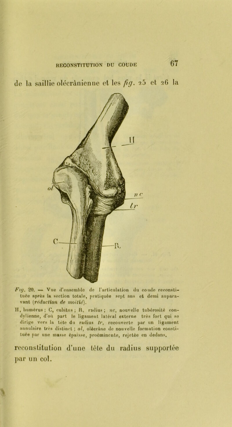 de la saillie olécranienne et les fg. 25 et 26 la FKJ. 20. — Vue il’enseml)lo de l'arliculalion du eoiule reeonsti- luée après la section totale, pratiquée sept ans et demi aupara- vant {réduction de moitié). II, humérus; C, cubitus; R, radius; ne, nouvelle tubérosité con- dylienne, d’où part le ligament laléial externe très fort qui so dirige vers la tète du radius tr, recouverte par un ligament annulaire très distinet ; o/, oléeréne de nouvelle formation consti- tuée par une masse éj>aisse, proéminente, rejetée en dedans, reconstitution d’une tôle du radius supportée ])ar un col.