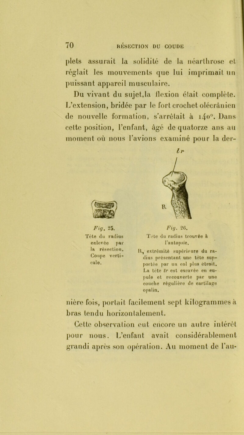 plets assurait la solidité de la néarlhrose et réglait les mouvements que lui imprimait un puissant appareil musculaire. Du vivant du sujet,la llexion élait complète. L’extension, bridée par le fort crochet olécranien de nouvelle formation, s’arrêtait à ido®. Dans cette position, l’enfant, âgé de quatorze ans au moment où nous l’avions examiné pour la der- 25. Tète du radius enlevée par la résection. Coupe verti- cale. Fi(j. 26. Tete du radius trouvée à l’autopsie. K, extrémité supérieure du ra- dius présentant une tète sup- portée par un col plus étroit, La tète tr est excavée en cu- pule et recouverte par une couche régulière de cartilage opalin. nièro fois, portait facilement sept kilogrammes à bras tendu horizontalement. Cette observation ont encore un autre intérêt j)Our nous. L’enfant avait considérablement grandi après son oj)ération. Au moment de l’aii-