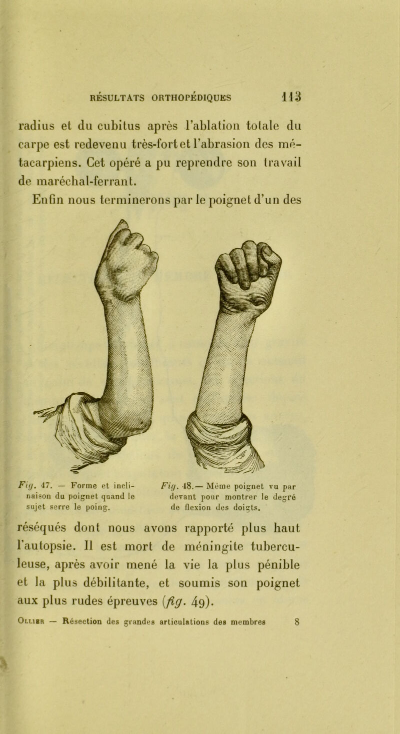 Fifj. 47. — Forme et incli- Fif/. l8.— Même poignet vu par riaison du poignet quand le devant pour montrer le degré sujet serre le poing. de flexion des doigts. réséqués dont nous avons rapporté plus haut l’autopsie. 11 est mort de méningite tubercu- leuse, après avoir mené la vie la plus pénible et la plus débilitante, et soumis son poignet aux plus rudes épreuves [fîg. 49). Olubr — Résection des grandes articulations des membres RÉSULTATS ORTHOPEDIQUES 113 radius et du cubitus après l’ablation totale du carpe est redevenu très-fort et l’abrasion des mé- tacarpiens. Cet opéré a pu reprendre son travail de maréchal-ferrant. Enfin nous terminerons par le poignet d’un des 8
