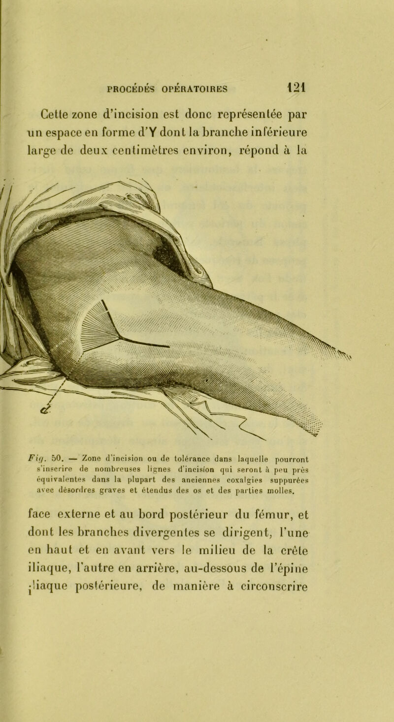 Cette zone d’incision est donc représentée par nn espace en forme d’Y dont la branche inférieure large de deux centimètres environ, répond à la Fifi. 50, — Zone d’ineision ou île tolérance dans laquelle pourront s’inscrire de nombreuses lignes d’incision qui seront à peu près équivalentes dans la plupart des anciennes coxalgies suppurées avec désordres graves et étendus des os et des parties molles. face externe et au bord postérieur du fémur, et dont les branches divergentes se dirigent, Tune en haut et en avant vers le milieu de la crête iliaque, l’autre en arrière, au-dessous de l’épine jliaque postérieure, de manière à circonscrire
