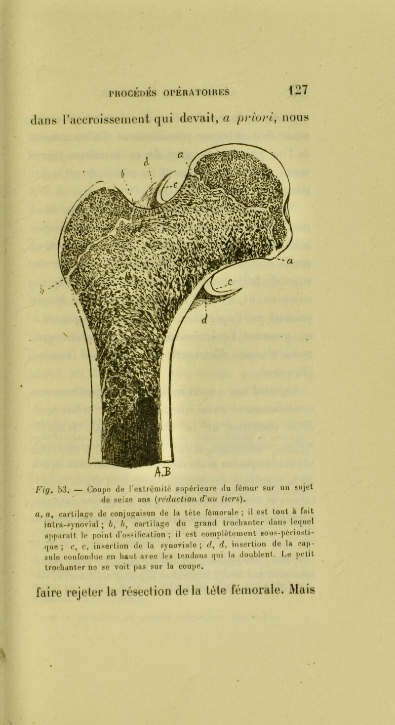 (luns l’iiccroissemont qui devait, a priori^ nous Fig, 53. — Coupc de rexlrémilé supérieure du fémur sur un sujet de seize ans {réduction d'un tiers). a, a, carlilaiçc de conjufçaison de la tète fémorale; il est tout à fait infra-synovial; 0, h, cartilage du grand trocliaulcr dans Imiuel apparaît le point d’ossilicalion ; il est complètement soiis-pénosti- <[ue ; e, c, insertion de la synoviale ; d, d, insertion de la cap- sule confondue en haut avec les tendons qui la iloublenl. I.e petit trochanter no se voit pas sur la coupe. faire rejeter la résection delà tète fémorale. Mais