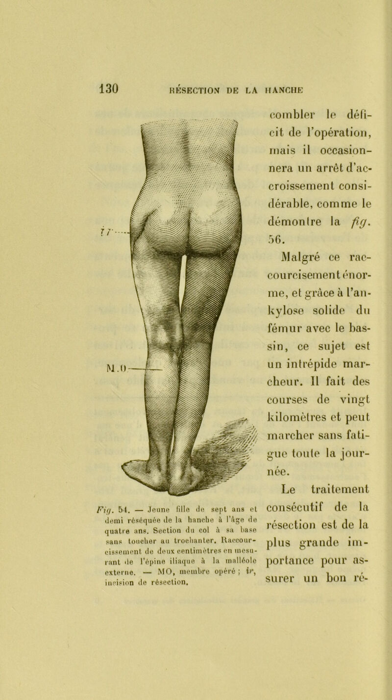 Fiçi, 54. — Jeune fille de sept ans et demi réséquée de la hanche à l'âge de quatre ans. Section du col à sa hase sans toucher au trochanter, llaccour- cisseinent de deux centimètres en mesu- rant de l’épine iliaque à la malléole externe. — MO, membre opéré; ir, incision de résection. combler le défi- cit de l’opération, mais il occasion- nera un arrêt d’ac- croissement consi- dérable, comme le démontre la frj. :>G. Malgré ce rac- courcisement énor- me, et grâce à l’an- kylose solide dn fémur avec le bas- sin, ce sujet est un intrépide mar- cheur. Il fait des courses de vingt kilomètres et peut marcher sans fati- gue toute la jour- née. Le traitement consécutif de la résection est de la plus grande im- ])ortance pour as- surer un bon ré-
