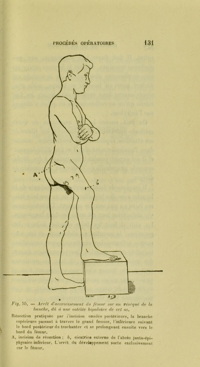 hnncJi(\ du à ntu' (mtcxlc hii>olaire de cet os. Résection prati([uéc par i’iiicision coiulée postérieure, la brandie supérieure [lassant à travers le grand fessier, l’inférieure suivant le bord postérieur du trochanter et se prolongeant ensuite vers le bord du fémur. A, incision de résection ; h, cicatrice externe de l’abcès juxta-épi- physaire inférieur. L’arrêt du développement porte exclusivement sur le fémur.