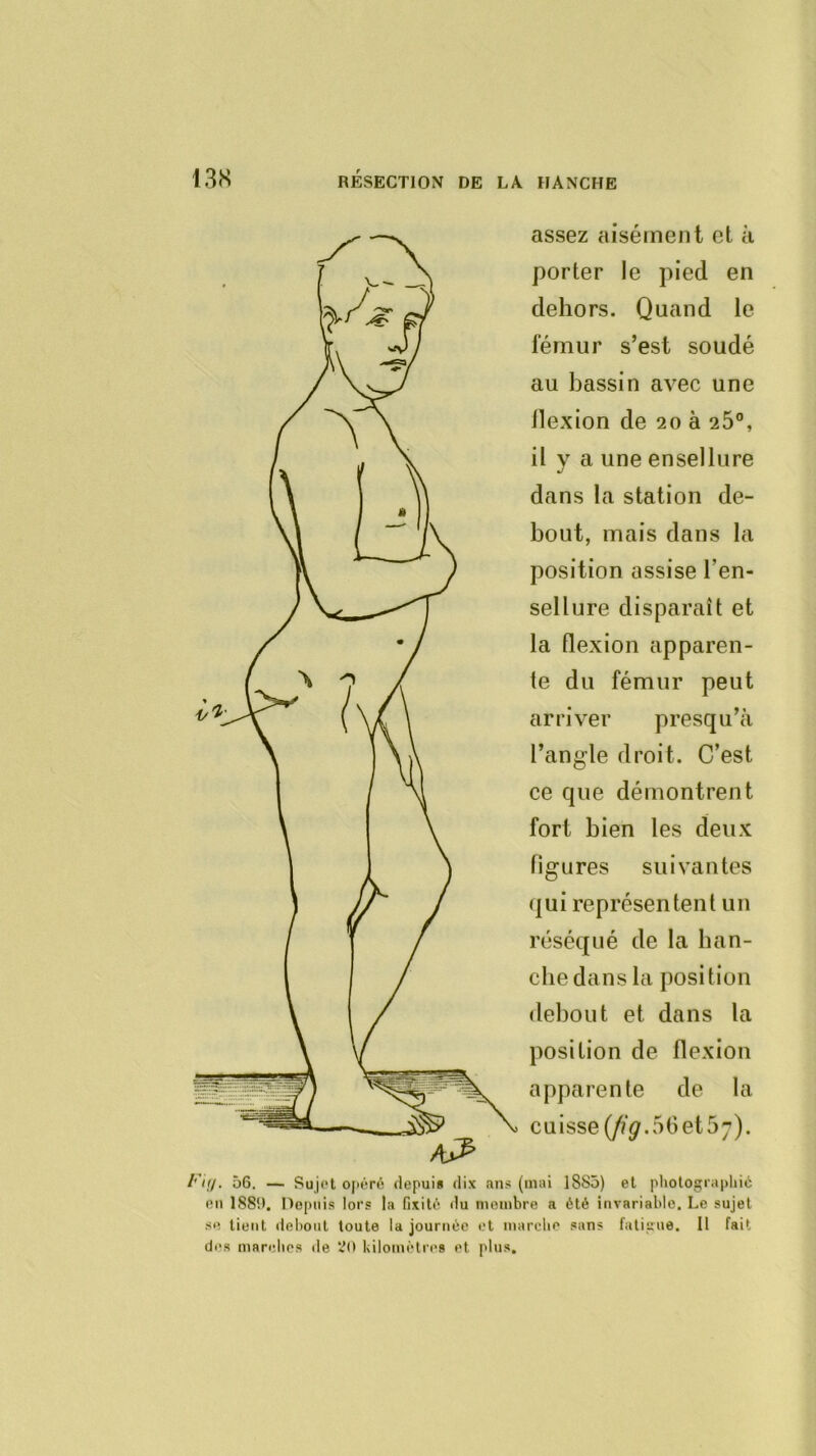 assez aisément et à porter le pied en dehors. Quand le fémur s’est soudé au bassin avec une llexion de 20 à 26°, il y a une ensellure dans la station de- bout, mais dans la position assise l’en- sellure disparaît et la flexion apparen- te du fémur peut arriver presqu’à l’angle droit. C’est ce que démontrent fort bien les deux figures suivantes (|ui représentent un réséqué de la han- che dans la position debout et dans la position de flexion apparente de la cU isse {fig. 5G et 57). /'’<//. 56. — Sujet o|iéré depuis dix ans (mai 1885) et pliotograpliié en 188i). nopuis lors la fixité du membre a été invariable. Le sujet se tient del)ont toute la journée et marche sans fatigue. Il fait des mandies de VÎO kilomètres et plus.